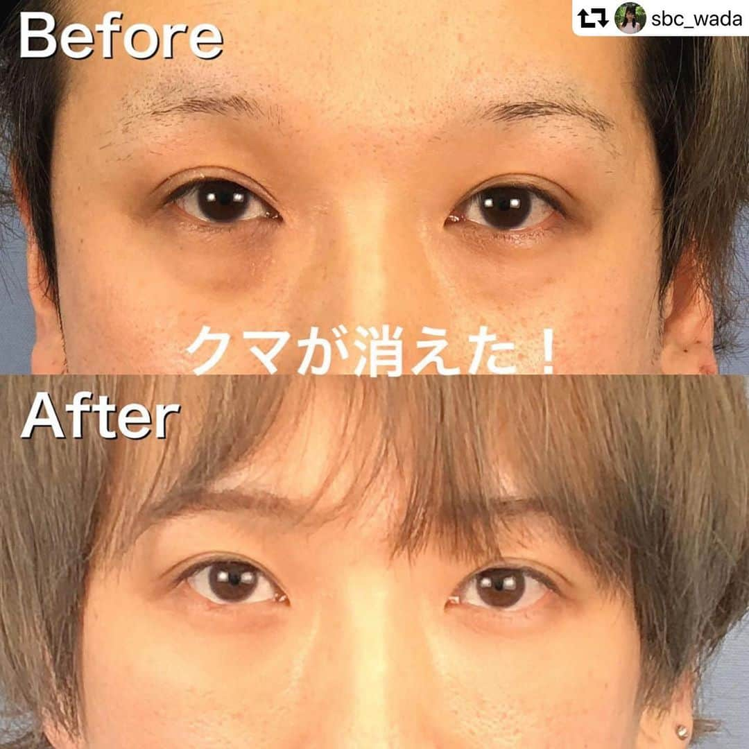 湘南美容外科 柏院さんのインスタグラム写真 - (湘南美容外科 柏院Instagram)「#repost @sbc_wada ・・・ 年とともに出てくる目の下のたるみ😵どうしても消えないクマ💦すっきり、若々しいお目元に戻りたいですよね✨ 今日は目の下の切らないたるみ取りを受けたモニター様の経過を紹介いたします。  目の下のクマが気になって来院された患者様。 目の下の切らないたるみ取り＋脂肪注入法を行いました✨ 術後はくまが無くなり、目の下〜頬にかけて自然にふっくらしました😊 目元がすっきりして若々しくなりましたね🌸 涙袋も目立って、魅力的なお目元になりました！  どうすれば自然に美しく若返えられるか…デザインのセンスに加え、目の下の解剖知識が必須のたるみ取り手術は、形成外科出身ドクターにお任せください👍 【モニター募集中 特別価格】 ❤️目の下の切らないたるみ取り❤️ 今だけ限定 56500円！！ 🧡脂肪注入法🧡 (採取作成料込) 103950円〜  目の下のたるみ取り モニター番号 No.020-0606  リッチ・フェイス(脂肪注入法) モニター番号 No.020-0558  インスタのプロフィールにあるURLからモニター募集をクリックしていただければ、私の募集中のモニターが出ますので、ご興味のあるものをお選びください💐  または、お電話で、和田のインスタのモニター応募を見たとお伝え下さい！ ． ☎️柏院 0120-489-750 . . 出勤日程 ． 【柏院】 3月 1,3,4,5,6,7,10,11,13,17,19,20,21,23,25,26,27,28,30,31日． 4月 1,2,4,5,7,9,10,11,12,14,16,17,20,21,24,25,28 ． 【松戸院】 3月 12日 4月 6,15,22,27日 ． ． あなたのスマイル叶える 和田真梨子  #湘南美容外科 #湘南美容クリニック #湘南美容外科クリニック #美容外科 #美容整形 #整形 #プチ整形 #美意識 #きれい #きれいになりたい #かわいい #可愛くなりたい #イケメン #美人 #目袋 #インスタ映え #アンチエイジング #フェイスライン #女医 #モニター #モニター価格 #整形モニター #美容 #若返り #2」6月16日 16時51分 - sbc_kashiwa