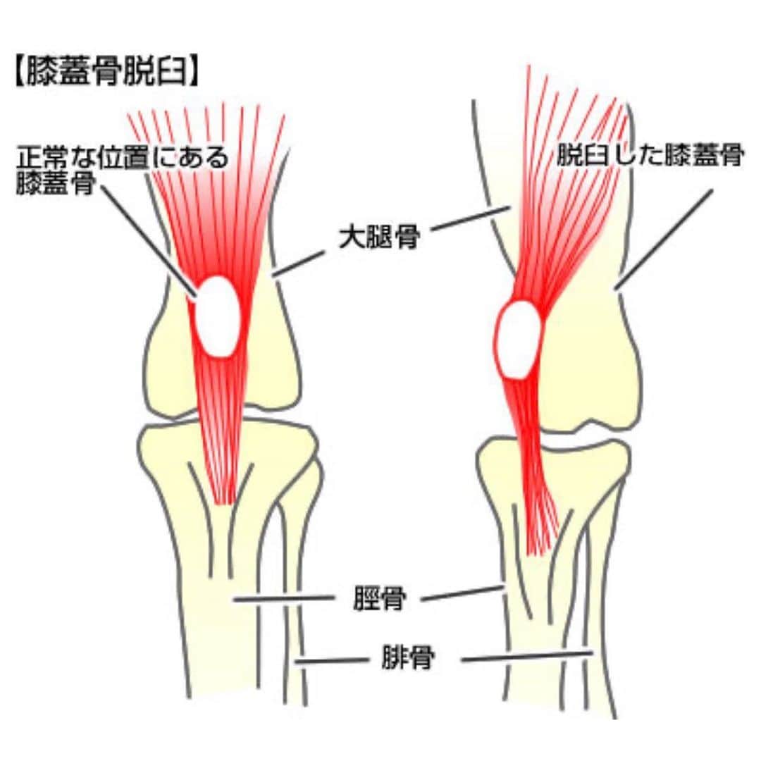 本田裕子さんのインスタグラム写真 - (本田裕子Instagram)「【一安心したら笑いに変える♡おてんば娘🐶まりんパテラ再手術 翌日】 . 昨日、急きょ愛娘🐶まりんの左の後ろ足の膝蓋骨脱臼（先天性パテラ）の再手術をして1日が経過しました。 . 昨日小出先生から『また来週にでも電話してね』って言われてたんだけど、 . 手術自体は大丈夫だと思っていたけれど、まりんの術後の様子だけ知りたかったので、わたしは我慢できず（笑）今日の朝一で岡山の病院に電話しました。 . . そしたら、看護師さん？受付の方？が出たので、『小出先生はお忙しいでしょうから、今日は先生に代わらなくて大丈夫ですので、まりんの様子だけ教えてください』って言ったら、 . 優しいお声で、『今ちょうど院長が降りてきたところですので、お待ちください』って言われ、小出先生と直接お話しできました🌟 . 昨日の手術前の状況は、『とにかく左後ろ足は開けてみんといかんのと、もう一度ひっぱりを強くしたい、溝ももう少し深めんといけんかもしれん』とのことでしたが、実際に開けてみたら、位置を固定するために吸収糸でとめていたのが、まりんが元気すぎて切れとった』らしいです。 . 先生曰く、『まりんが元気すぎて、元気パワーに糸が負けたんよ』って言ってた😅 . だから、 しっかりやり直してくれたみたい。 . 12日前に後ろの両足を手術した時は、 骨を切ったり、削ったりしたけど、 今回は骨は触ってなくて、 手術時間もかなり短く、 20分くらいで終わったそうです。 . けど、全身麻酔をして切ってはいるから傷の具合もあるし、また暫くは鎮痛剤の中に麻薬みたいなのを入れて痛みの処置をしていただいていて、あとは時間薬になるけれど、今回も本人は麻酔の覚めも順調だったから大丈夫、とのこと。 . . ふう😌（一安心です🙏） . . まり〜ん❣️ . もう手術は終わったから あとちょっとだよ♡ . . てか、 元気すぎて、 糸が元気パワーに負けて 再手術って。。。w . . それでまた 痛い思いして。。(◞‸ლ)😓 . . でも、まりんのこの生命力なくして 昨年のあの状況から 門脈シャントの大手術は 乗り越えられんやったと思うんです。 . だから、まりんに会ったら よく頑張ったね！！♡ まりん、ありがとう！！って いっぱいハグして 安心して家でゆっくり 休ませてあげたいです❤️ . . 今は痛いと思うけど、小出動物病院は、 国内でもあまり普及していない 麻薬性鎮痛薬の使用可能な病院で、 確実な鎮痛処置を行ってくれてるから、 ほんと有難いです。 . . …… あと、ここからは（も）記録用として、 今回のまりんの手術メモを📝 （私なりに今回もまた更にいっぱい勉強しました😅） . . まりんの場合は、骨を切ったり削ったりしたのと一緒に、図のように（図の写真はネットからお借りしました）膝の脇にある“種子骨”っていう小さな丸い骨と “脛骨“に糸をかけて、外側にテンション（張力）をかける方法がとられたのだと思います。 （また退院時に実際のまりんのデータや写真等と共に先生から詳しく説明を受けると思います） . . この目的は、脛骨が内側に内転するのを矯正することにあって、放っておくと内転する脛骨を糸で外側にひっぱって矯正することみたいです。 （この糸は数ヶ月〜半年くらいで体内に吸収されたり、切れてしまうみたいで、多分まりんが元気すぎて糸が切れるのが早すぎて、術後、再度脱臼してしまい、昨日のオペではその糸が切れていたのが確認できたので、骨は前回調整したまんまでいけたのかなと思っています。） . . …… なんにせよ、ほんと一安心です🙏 . お騒がせしましたと共に、今回もあたたかいメッセージや御気持ち、応援や祈りを本当にありがとうございました♡ . . 今日の動画は、お蔵入りにしていた まりんが約1ヶ月前に 初めて嬉ションしたときの動画と、 （しかも1日に2回も嬉ション🤣） . 母ちゃんの 昭和っぽいw お笑い汗拭き動画でした🤣 . （一安心したら笑いに変換！笑） . . …… #愛娘まりん #忘備録 #先天性パテラ手術 #パテラ手術 #パテラ再手術 #昨日の手術 #手術翌日 #先天性門脈シャント #門脈シャント術後 #元気すぎて #糸が切れた #膝蓋骨脱臼 #脱臼 #吸収糸 #麻薬性鎮痛薬 #生命力 #小出動物病院 #一安心 #ありがとう #昭和っぽい #お笑い系親子 #笑いは大事あるよ #本田裕子」6月16日 21時27分 - rinrin_yuko