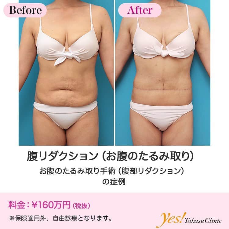 高須クリニックのインスタグラム：「👨🏻‍⚕️高須幹弥医師からのコメント✨⠀ 30代後半女性の患者様で、お腹の脂肪と皮膚のたるみと妊娠線、皮膚割れを改善したいというご要望で来院されました。 診察させていただいたところ、お腹回り全体にたくさん皮下脂肪がついており、へそ回りの皮膚が大量にたるんでいました。 へそ回りの余っている皮膚には妊娠線、皮膚割れがしっかりと刻まれていました。 患者様のご希望は、「お腹の脂肪をとって、皮膚のたるみをスッキリさせて、妊娠線もとりたい」というご要望でした。 それら全てを改善するにはお腹のたるみ取り手術腹部リダクションしかないため、その手術の説明をさせていただいたところ、納得され、手術をすることになりました。 全身麻酔下に、上腹部、下腹部、ウエスト、わき腹の脂肪吸引をし、へそ回りの妊娠線が刻まれている皮膚を中心に皮膚切除し、新たにへそを形成しました。 術後はお腹前面のへそ下に3/5周程度の細い1本の傷跡が残りましたが、たるみがとれてスッキリしました。 この患者様のように、お腹の脂肪がついているだけではなく、皮膚が大量にたるんでおり、妊娠線や皮膚割れもある場合、脂肪吸引だけをすると、脂肪の量は減りますが、皮膚は余計にたるんでしまい、妊娠線や皮膚割れを改善させることもできません。 全てを改善するには腹部リダクション手術しかありませんが、必ず傷跡は残るし、年月が経っても傷跡が完全に消えることはありません。 傷跡が残っても良いので、たるみや妊娠線、皮膚割れをとってスッキリさせたいという人にご検討いただきたい手術です。 ---------------------------------------------------- 🌈料金✨⠀ ●腹リダクション（お腹のたるみ取り） ¥1,600,000【東京、横浜、名古屋、大阪】 ---------------------------------------------------- ⚠️リスク・副作用・合併症✨⠀ ●腹リダクション（お腹のたるみ取り） 手術後に処方する抗生剤や痛みどめによるアレルギー症状 仕上がりのわずかな左右差（完璧なシンメトリーは不可） 傷跡が肥厚性瘢痕やケロイドになる可能性 手術後の血腫 --------------------------------------------------- 😊施術についての詳細✨⠀⠀ https://www.takasu.co.jp/photo/hara001.html ---------------------------------------------------- 📞ご予約・お問い合わせ✨⠀ 0120-5587-10⠀ https://www.takasu.co.jp/cgi-bin/form/contact.cgi ※症例写真や施術に関するご質問なども上記までお願い致します。 ---------------------------------------------------- #腹リダクション #腹部リダクション #お腹のたるみ取り #お腹の脂肪をとりたい #皮膚のたるみ改善 #妊娠線改善 #妊娠線をとりたい #皮膚割れ改善  #皮膚 #美容 #美肌 #エイジングケア #美容整形 #美容外科 #美容クリニック #美容好き #美容皮膚科 #モニター #モニター募集 #高須クリニック #高須クリニック名古屋 #高須幹弥 #整形したい #プチ整形 #症例 #症例写真 #可愛くなりたい #可愛い #美人」
