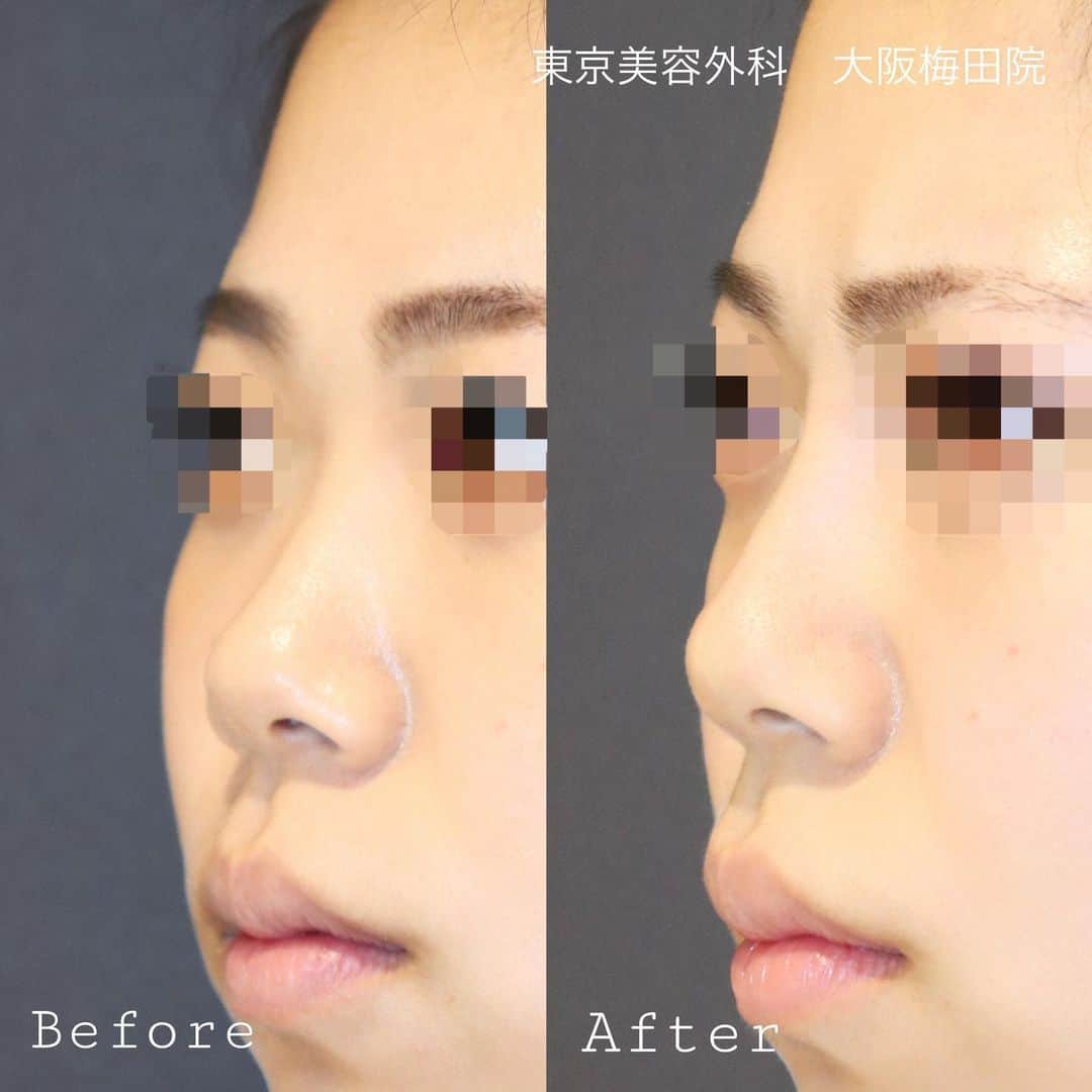 東京美容外科公式さんのインスタグラム写真 - (東京美容外科公式Instagram)「. ☑️キレイな鼻筋が欲しい ☑️低い鼻をなんとかしたい ☑️離れ目が気になる と鼻に悩みやコンプレックスを持ちながらも、 . 💬鼻にメスを入れるのが怖い！ 💬ダウンタイムがあるのが嫌！ と、鼻の手術に挑戦できない方も多く見られます。 . そんな方にオススメなのが #鼻ヒアルロン酸 注入✨ 鼻ヒアルロン酸注入の1番のメリットは 💎ダウンタイムがない💎ことなんです♡ . 今回のモニターの方が使用したヒアルロン酸は #クレヴィエル です💡 クレヴィエルのヒアルロン酸濃度は50mg/mlで、 ⚜️高密度&高濃度⚜️なヒアルロン酸なんです✨✨ 高濃度で弾力性があるので、 鼻やアゴなどの形成に適しています✨ . 鼻の形や、横顔にお悩みがある方！ クレヴィエルで美しい#eライン を手に入れて、 #横顔美人 になりませんか❔💎 . webカウンセリング受付中👩🏼‍⚕️👩🏼‍⚕️ ご気軽にご相談下さい。 ▫️▫️▫️お問い合わせはこちらから▫️▫️▫️ 📞フリーダイヤル 0120-658-958 (コールセンター受付時間　9:00〜21:00) . 🟩LINE予約 @ tkc110  #東京美容外科#東京美容外科大阪梅田院#美容整形#美容外科#美容クリニック#美容#美活#整形#プチ整形#ダウンタイム#ヒアルロン酸#鼻ヒアルロン酸#クレヴィエル#ジュビダーム#ボリューマ#鼻整形#フェイスライン#鼻クレヴィエル#切らない鼻整形#鼻尖形成#鼻中隔延長#cleviel#hyaluronicacid#cosmeticsurgery」6月19日 14時07分 - tokyobiyougeka_jimukyoku