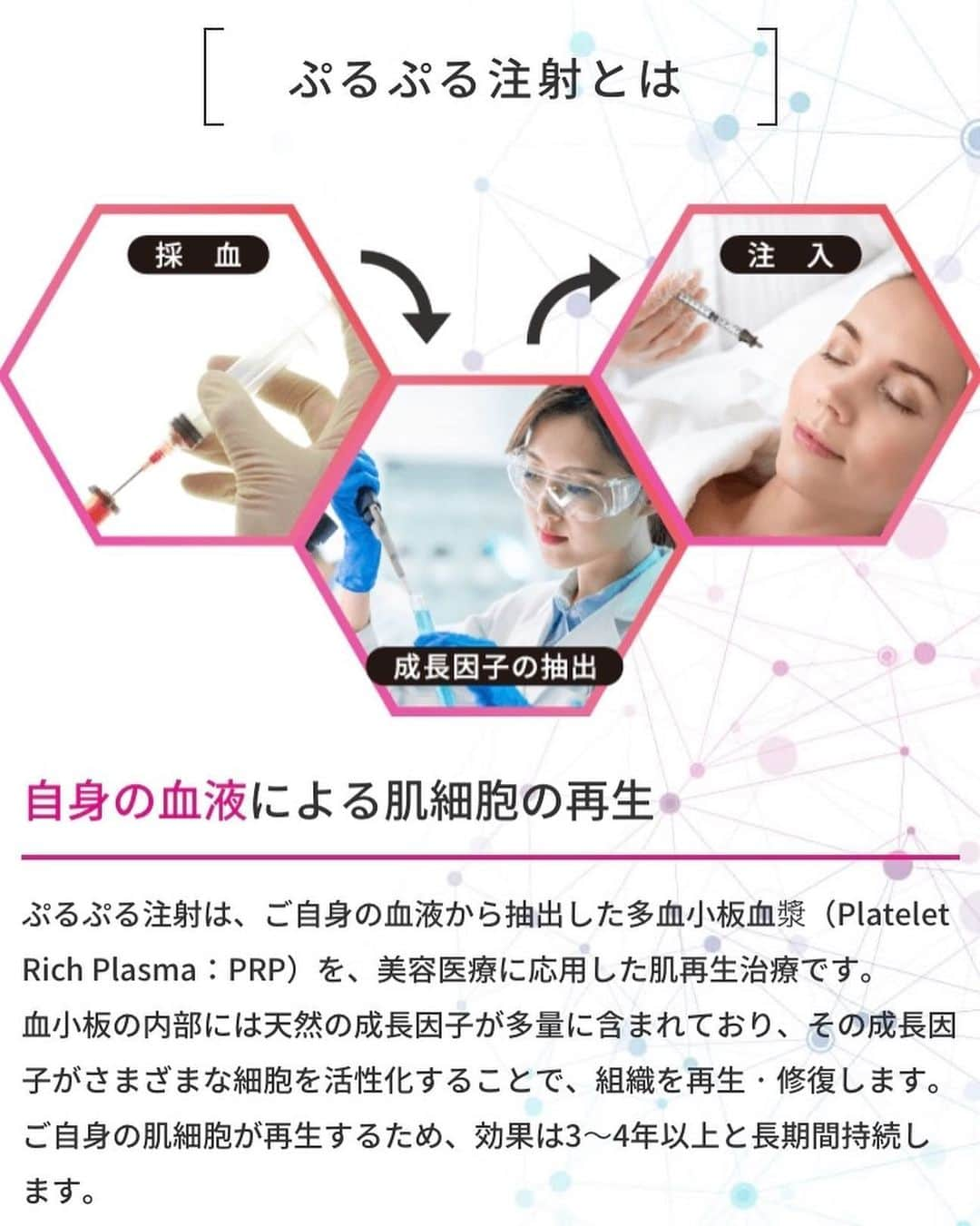 難波サキさんのインスタグラム写真 - (難波サキInstagram)「赤羽にあるプルージュクリニックへ🏥 @pruge_clinic  ここのダーマペンは最強なのです✨他ではないPRPでダーマペンができちゃうよ！まさに美容の穴場🤣  施術の様子をムービー撮ってみたよ😊麻酔クリームを塗るから痛くないよ！ダウンタイムは個人差があるけど約一週間はお肌に赤みがある感じだよ！  ぷるぷる注射(PRP)は、自分の血液から抽出した多血小板血漿を、美容医療に応用した肌再生治療✨  血小板の内部には天然の成長因子が多量に含まれててその成長因子が細胞を活性化することで、組織を再生・修復します！  自分の肌細胞が再生するから異物じゃなくて安心して受けられるよ😊  今回はぷるぷるフェイス、ダーマペンでお肌に微細な穴を無数にあけて、PRPを真皮までダイレクトに導入！  真皮の「自己治癒力」と「美肌成分産生作用」の相乗効果で最強のアンチエイジングなの！ #美容オタク#美容ネタ#アンチエイジング #プルージュクリニック#プルプル注射 #プルプルフェイス#PRP#成長因子」6月19日 21時05分 - sakinanba