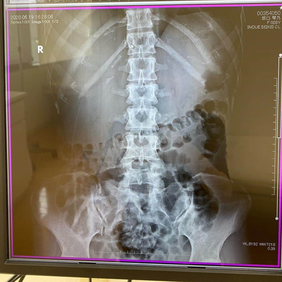 dj..琴さんのインスタグラム写真 - (dj..琴Instagram)「神社に行くと身が清められる。  見かけると立ち寄ってしまう。  #圧迫骨折 をしていました。  腰痛がすごく激しくて。。 MRI撮って精密検査をして知って  #リハビリ生活 が来週から始まる  身体がだるいと1日が本当きつい、、、 #健康第一でいきましょう」6月20日 14時51分 - koto5555