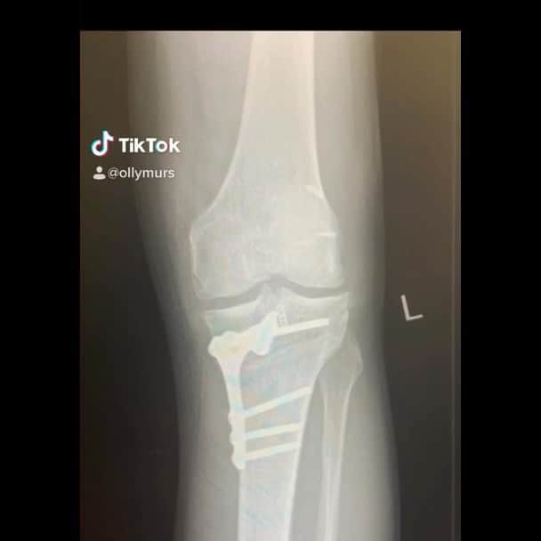 オリー・マーズのインスタグラム：「It’s been 12 hard Months after my ACL reconstruction! I can’t tell you how tough it’s been mentally aswell as physically but after being told if I didn’t do this I’d need a Knee replacement at 40 🤯 So I needed to act! still have a long way to go but wow it feels good! Here is a little short video to show my journey x thanks to my incredible physio @johngreenphysiotherapy & the best PT @rob_solly for pushing me and keeping me focused x I owe you both a lot! Thank you xx 😘」