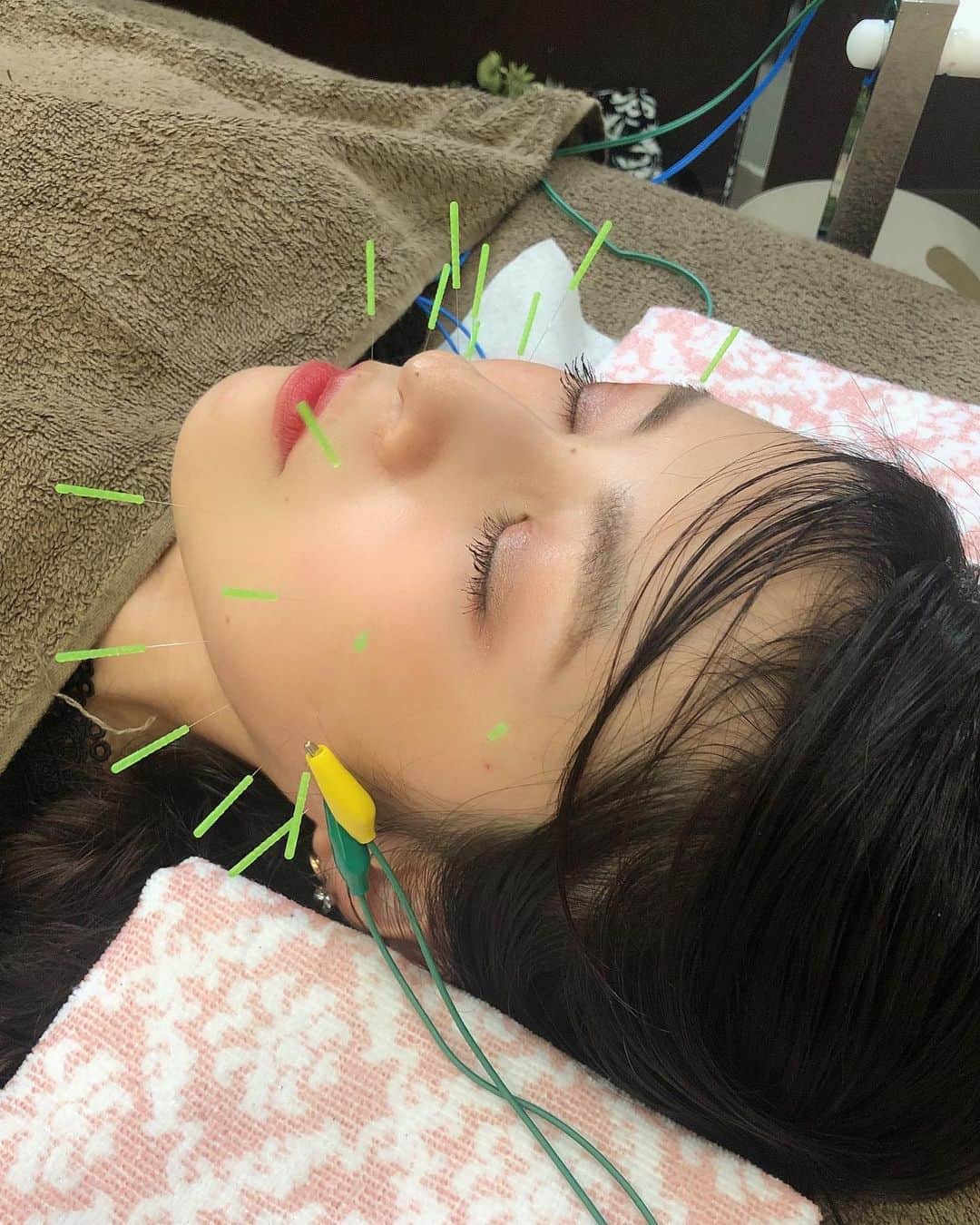 齋藤優紀さんのインスタグラム写真 - (齋藤優紀Instagram)「@shozushima_takahiro EXE鍼灸整体院で、美容針をうけてきました🥰  顔に直接針を刺すことで、深層の筋肉を刺激してほうれい線にアプローチ😊 さらに肌に傷をつけることでターンオーバーが促進されるそうです😆✨ 針怖いなって思うかもだけど、医療用の細い針なので、あれ？はいった？？ってくらいです😌⭐️ さらにそこに電気を流してもらって、深層の筋肉にアプローチ🥰口角があがって、嬉しかったです😊  駒沢大学駅の近く、イケメン鍼灸師の小豆島さんに会いに是非行ってみてくださいねー😊✨✨ #EXE鍼灸整体院 #世田谷整体 #美容鍼 #小顔矯正 #整顔 #小顔 #リフトアップ #acupuncture #pr #コラボベース」6月20日 23時04分 - yuki_fit0828