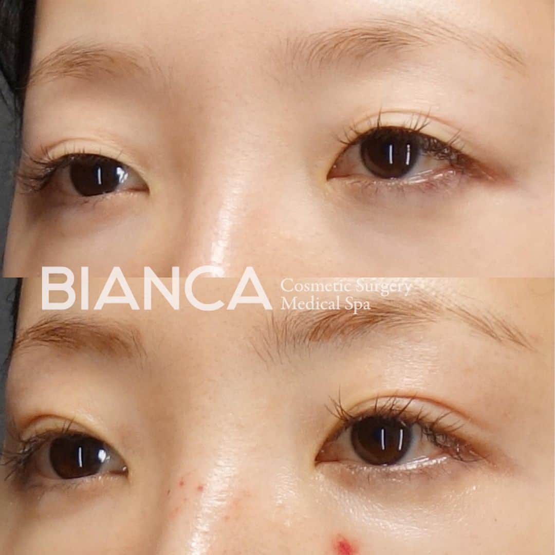 のインスタグラム：「【タッキング法×脂肪取り】 ﻿ ﻿ 切らない眼瞼下垂の手術であるMT法（タッキング法）に上まぶたの脂肪取りを組み合わせました👩‍⚕️﻿ ﻿ お目元の重たさがなくなり、すっきりと開きが良くなりました💕﻿ ﻿ 上 術前﻿ 下 術後1ヶ月﻿ ﻿ ﻿ MT法は、特殊な極細⽷でまぶたの裏側の筋⾁を縫い縮めることで⽬の開きを良くする⼿術です。 ﻿ 🌸瞼の開きが悪く⿊⽬が隠れる﻿ 🌸眠そうに⾒える﻿ 🌸⽬つきが悪いと⾔われる﻿ ﻿ などの眼瞼下垂特有の症状を改善することができます✨﻿ 眼瞼下垂が改善されると、頭痛や肩こり、全⾝の疲労感も緩和されます❣️﻿ その他、三重やくぼみ目の解消にも効果的です🥰﻿ ﻿ 現在、お得なモニター様も募集しています。﻿ 私も適応かも？と思った方は、一度ぜひカウンセリングにお越しください✨﻿ ﻿ ﻿ 💉眼瞼下垂（MT法）﻿ 💴298,000円﻿ ﻿ 💉上瞼脂肪取り﻿ 💴198,000円（埋没と組合せた場合は100,000円）﻿ ﻿ 😷腫れ 内出血:数日〜1週間程度﻿ ﻿ ﻿ ⚠️ご予約の際は﻿ 『Dr Yuu（辻沢）のインスタ見た』の一言をお願いします👩‍⚕️✨﻿ ﻿ 📍BIANCA CLINIC﻿ ✔︎表参道院﻿ 03-6433-5994﻿ 東京都港区南青山5-11-10  南青山511ビル 2F﻿ ✔︎銀座院﻿ 03-6263-2690 ﻿ 東京都中央区銀座1-5-6 銀座レンガ通り福神ビル 4F﻿ 診療時間 10:00〜19:00﻿ 年中無休（年末年始を除く） ﻿﻿ ﻿ 6月勤務日🎍﻿ 表参道院﻿ ↪︎1 3 5 9 12 13 15 18 20 22 24 27﻿ 29 銀座院﻿ ↪︎4 6 10 16 17 21 23 28﻿ ﻿ #美容好き#プチ整形#美魔女#美容好きな人と繋がりたい#美容垢#綺麗になりたい #美容皮膚科 #美容外科 #cosmeticsurgery #plasticsurgery #biancaclinic #ビアンカクリニック  #followｍe #フォローミー #銀座 #女医 #モニター募集 #モニター募集中#若返り #イメチェン #二重切開 #二重埋没 #二重整形  #二重になりたい #ヒアルロン酸 #女医 #アンチエイジング #埋没法 #beauty #二重埋没法 #dryuu目」