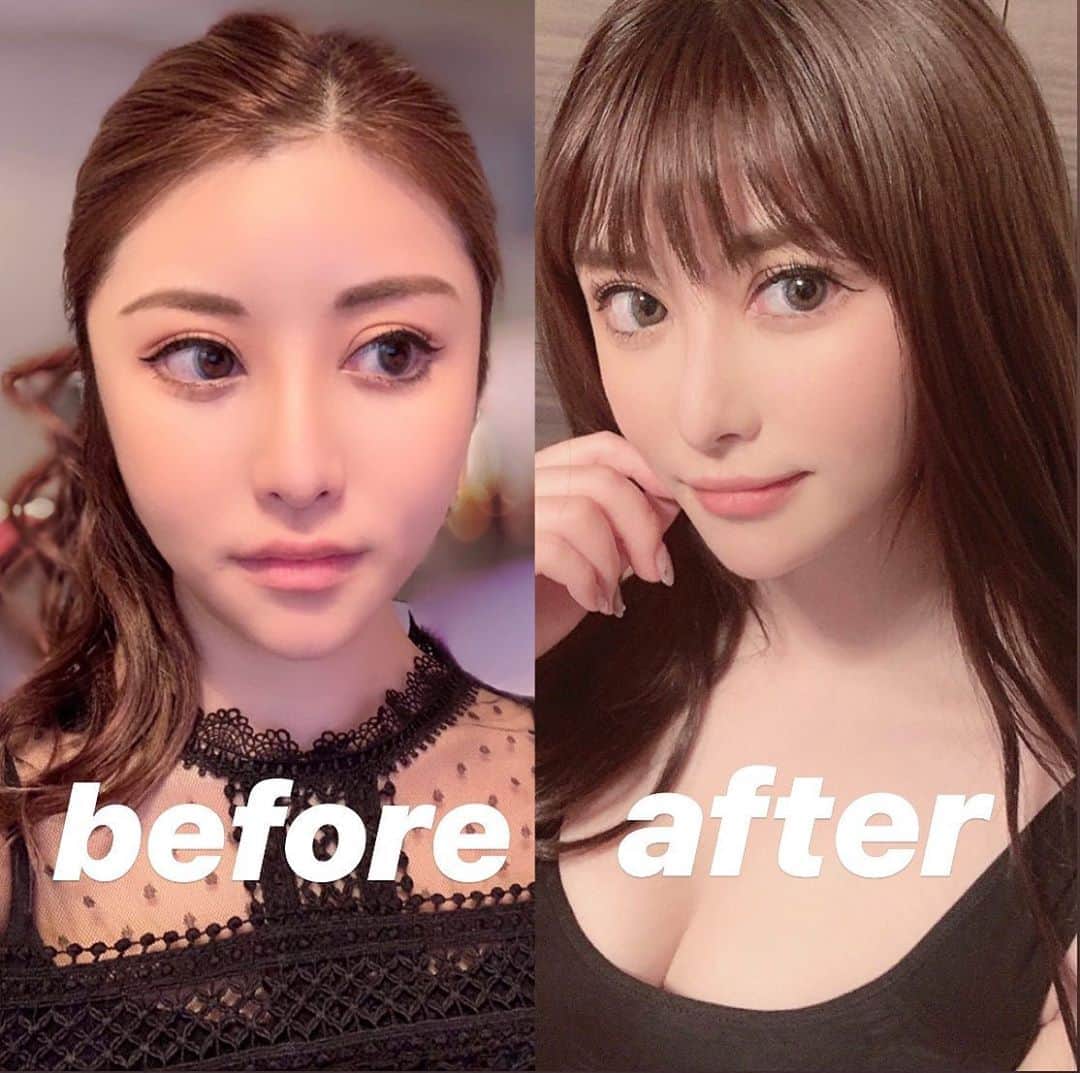 のインスタグラム：「東京中央美容外科中野院さん@tcb_nakanoでTCB式小顔美肌再生を磯村先生@tbc_isoにして頂いて3ヶ月経ちました🙆‍♀️💭 ほっぺやVラインがはっきりして維持されているのでとても満足しています🥺❤️ ありがとうございます👱🏻‍♀️❣️ #美容整形ならTCB東京中央美容外科 #リフトアップならTCB東京中央美容外科 #東京中央美容外科中野院 　#tcb式小顔美肌再生 #小顔美肌再生 #東京中央美容外　 #美容外科 #中野 #磯村亮輔 #小顔なら磯村先生 #磯村先生 #リフトアップ #PR」