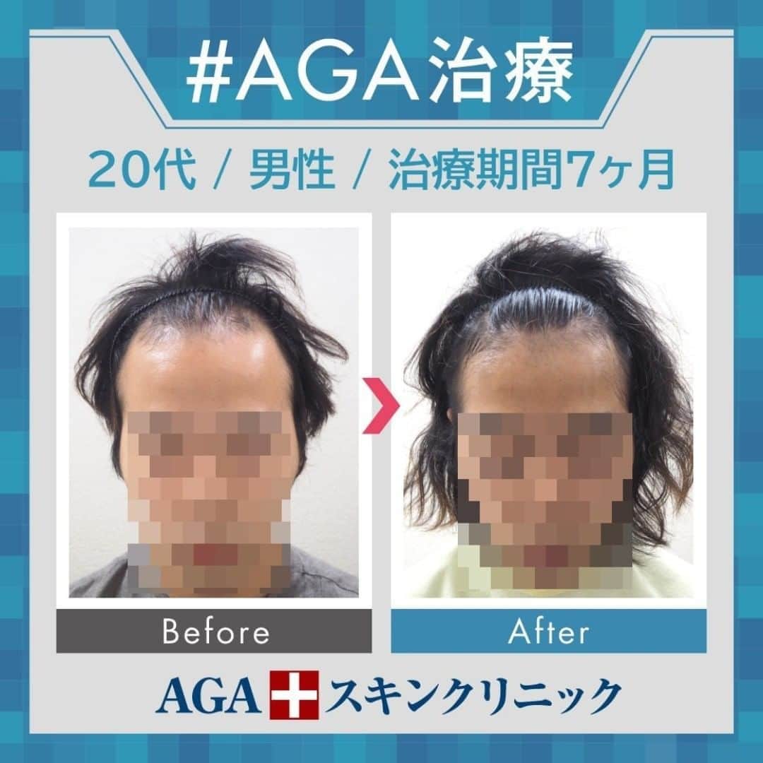 【公式】AGAスキンクリニックさんのインスタグラム写真 - (【公式】AGAスキンクリニックInstagram)「🎇AGAスキンクリニック　Before⇒After🎇 . 〇20代男性のケース 〇治療期間7ヶ月 〇治療内容 ⇒オリジナル発毛薬 ⇒Dr'sメソ治療（AGAメソセラピー） . ７ヶ月で生え際に大きな変化が❗ ヘアセットやオシャレの幅もぐんと広がりそうです🤗 . クリニックなど詳細は@aga_clinicより公式HPをチェックしてみてください🐵🎈 . #agaスキンクリニック  #aga #薄毛  #抜毛 #発毛  #育毛  #治療  #薬  #ミノキシジル #ヘアー #agaスキンクリニック症例  #aga治療  #男性ホルモン #フィナステリド #梅雨対策髪  #梅雨対策ヘアー」6月24日 11時05分 - aga_clinic