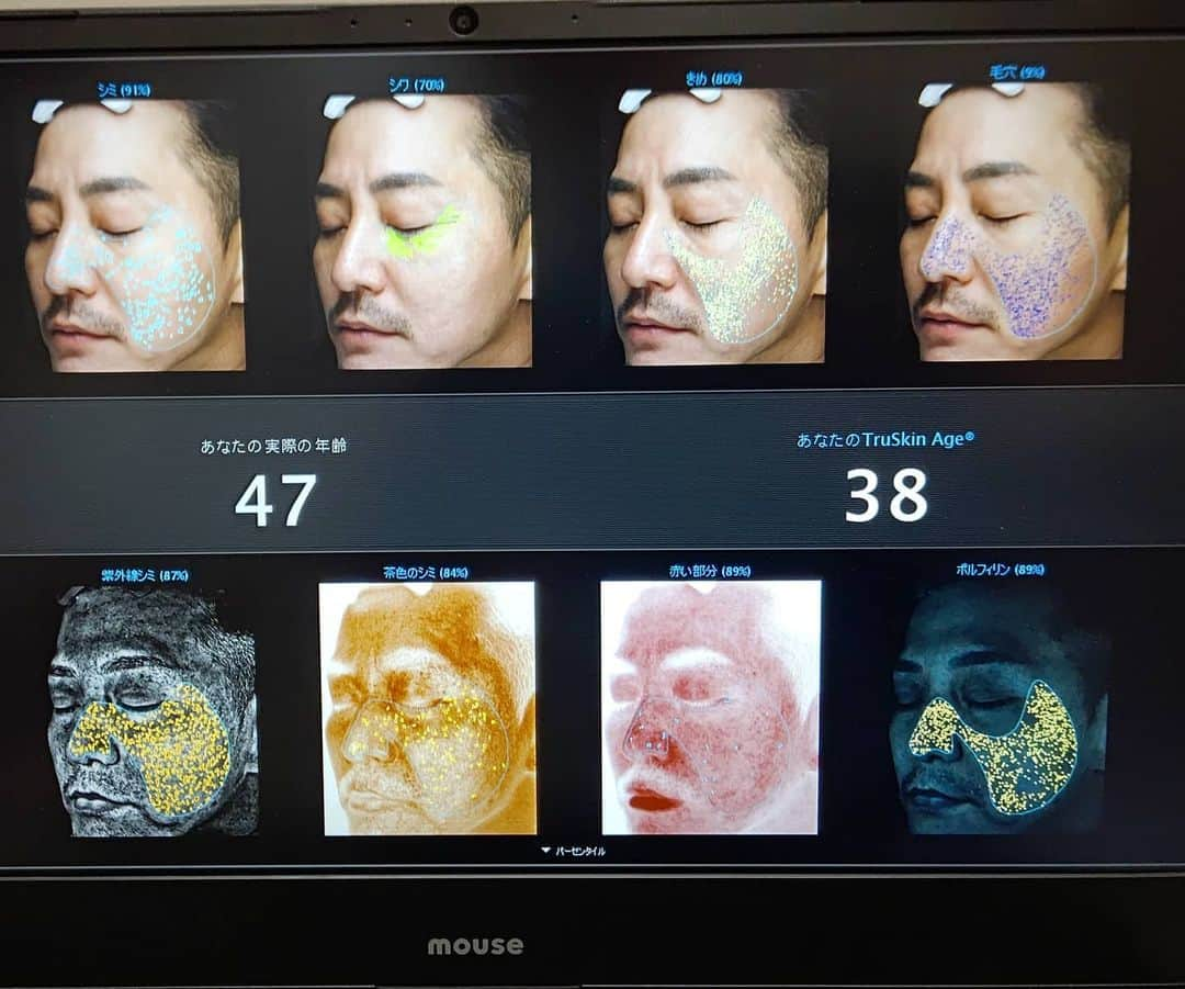 福川雅顕さんのインスタグラム写真 - (福川雅顕Instagram)「. @forever_skin_clinic  . 定期的にお世話になってます . 施術のお客様には ４０年後までのシュミレーションとシミ、シワ、たるみ等の項目別点数と肌年齢を調べてくれます ３８歳でした 全然足りない #目指せ5歳肌 毛穴以外は高得点 毛穴さえなくなれば #便器のような肌になりたい . 初の表面が赤くならない フラクショナルレーザー 画期的すぎる感覚でした 表面は普通だけど、皮膚の中がホカホカと炎症おきてる感じ 皮膚の中だけダウンタイム . あとここは マッサージピールの技術がハンパなく上手い #あんなの薬塗るだけじゃんって言ってる人 #美容オタクなんて名乗ってほしくない . #美容  #美容男子  #美容おたく #美容おじさん」7月19日 14時59分 - masaakifukugawa