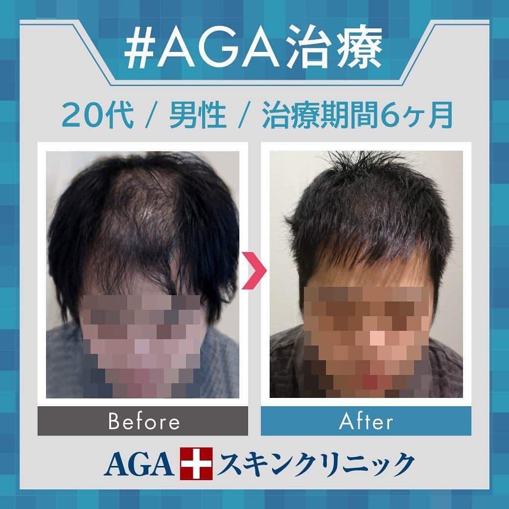 【公式】AGAスキンクリニックさんのインスタグラム写真 - (【公式】AGAスキンクリニックInstagram)「⭐️AGAスキンクリニック　Before⇒After⭐️ . 〇20代男性のケース 〇治療期間6か月 〇内容 ⇒オリジナル発毛薬 ⇒Dr'sメソ治療（AGA メソセラピー） . 頭頂部から前頭部にかけてのAGA進行でお悩みだった方です。 6ヶ月でかなり改善されてきています👀 これから月を追うごとにさらに良くなっていきます✨ . AGAは早期治療が肝心です。 クリニックなど詳細は、@aga_clinic より公式HPをチェックしてみてください🥰 . . #AGAスキンクリニック #AGA #薄毛 #抜毛 #発毛 #育毛 #治療 #薬 #ミノキシジル #ヘアー #AGAスキンクリニック症例 #AGA治療 #男性ホルモン #フィナステリド #M字 #てっぺん #円形」7月20日 11時17分 - aga_clinic