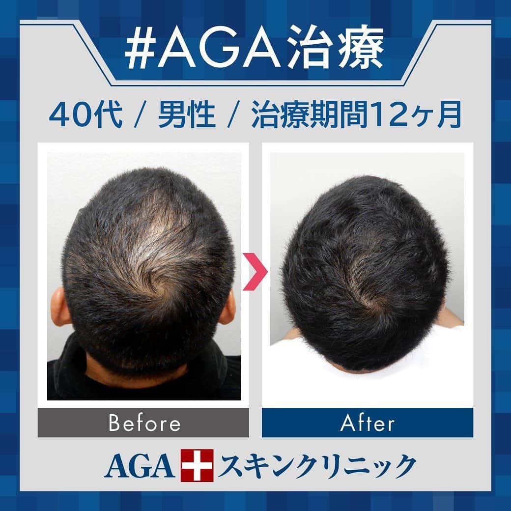 【公式】AGAスキンクリニックさんのインスタグラム写真 - (【公式】AGAスキンクリニックInstagram)「⭐️AGAスキンクリニック　Before⇒After⭐️ . 〇40代男性のケース 〇治療期間12か月 〇内容 ⇒オリジナル発毛薬 ⇒Dr'sメソ治療（AGA メソセラピー） . 頭頂部のAGA進行でお悩みだった方です。 つむじ周りの進行は外側から埋まるように改善されていきます！ こちらの患者様はきれいに埋まっていますね✨ . AGAは早期治療が肝心です。 クリニックなど詳細は、@aga_clinic より公式HPをチェックしてみてください🥰 . . #AGAスキンクリニック #AGA #薄毛 #抜毛 #発毛 #育毛 #治療 #薬 #ミノキシジル #ヘアー #AGAスキンクリニック症例 #AGA治療 #男性ホルモン #フィナステリド #M字 #てっぺん #円形」7月20日 12時27分 - aga_clinic