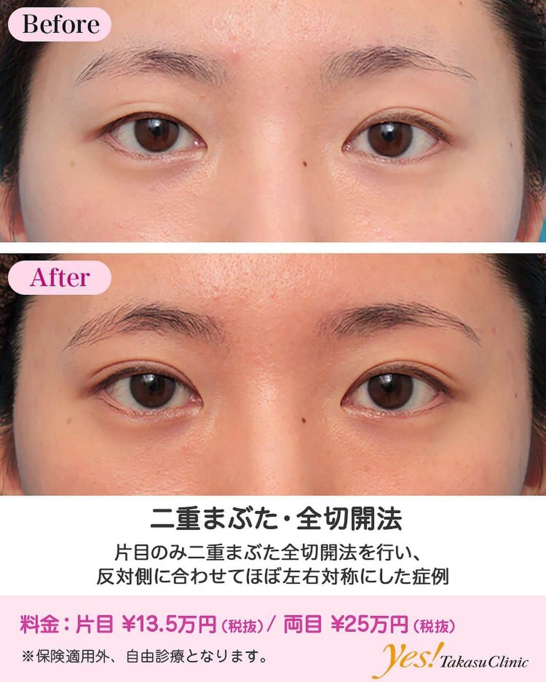 高須クリニックのインスタグラム：「👨🏻‍⚕️高須幹弥医師からのコメント✨⠀ 20代女性の患者様で、右目の二重手術を希望されていました。 診察させていただいたところ、左目は綺麗な天然の二重まぶただったのですが、右目は奥二重の状態で、明らかな左右差がありました。 患者様のご希望は、右目を切開法で二重にし、半永久的にとれない左右対称の二重にしたいということでしたので、右目の二重まぶた全切開法を行うことになりました。 なるべく左右対称になるように、左目のラインに合わせてデザインし、切開しました。 特別余分な脂肪はなかったので、脂肪の除去はしませんでした。 手術後はほぼ左右対称の自然な二重になりました。 ---------------------------------------------------- 🌈料金✨⠀ ●二重まぶた・全切開法 片目 ¥135,000 / 両目 ¥250,000【東京、横浜、名古屋、大阪】 脂肪切除をする場合や埋没法の糸を抜去する場合の費用も含まれております。 ---------------------------------------------------- ⚠️リスク・副作用・合併症✨⠀ ●二重まぶた・全切開法 まぶたの強い腫れ（術後／個人差があります） 内出血（術後） 仕上がりの左右差（片目ずつ手術をする場合） 不自然な二重（無理に二重の幅を広げた場合） 仕上がりのわずかな左右差（完璧なシンメトリーは不可） 仕上がりが完璧に自分の理想の形にならないことがある 二重のラインの癒着がとれる可能性 手術後の血腫 --------------------------------------------------- 😊施術についての詳細✨⠀⠀ https://www.takasu.co.jp/photo/sekkai071.html ---------------------------------------------------- 📞ご予約・お問い合わせ✨⠀ 0120-5587-10⠀ https://www.takasu.co.jp/cgi-bin/form/contact.cgi ※症例写真や施術に関するご質問なども上記までお願い致します。 ---------------------------------------------------- #二重まぶた #全切開法 #切開法 #二重整形 #二重手術 #左右対称の二重  #皮膚 #美容 #美肌 #エイジングケア #美容整形 #美容外科 #美容クリニック #美容好き #美容皮膚科 #モニター #モニター募集 #高須クリニック #高須クリニック名古屋 #高須幹弥 #整形したい #プチ整形 #症例 #症例写真 #可愛くなりたい #可愛い #美人」