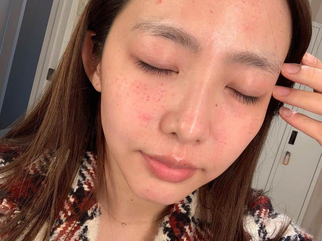 松村香織さんのインスタグラム写真 - (松村香織Instagram)「久しぶり投稿💨  タイミング逃すと インスタ 更新出来なくなる病😇  インスタ映えする写真 ないんだもん😭  過去写真を 少しづつ載せてこう  つぎこそ🔥笑  まだこっちでしてない 色んなお知らせも しなきゃだし🙂‼️  ·﻿ ﻿ ﻿· ﻿ ·﻿ ﻿ ﻿·﻿ ﻿ ﻿· ﻿ ·﻿ ﻿ ﻿· ﻿ ·﻿ ﻿ ﻿·﻿ ﻿ ﻿· ﻿  あとだいぶ前だけど HAABクリニックの 新宿院が開院したので シャネル注射を やってきたー✨  痛みもほとんどなしで つるっとしてくすみがとれて ハリがでて満足🥺  年齢的にも肌には お金をかけないと そろそろやばい〜😨  アンチエイジングとの 戦いですね  正直基礎化粧品やサプリだけじゃ 限界がやっぱりあって 医療やエステなど多少は 取り入れないと5年後手遅れに なってると思う。  このときは次のお仕事まで 時間を取れたので 注射を深めにやってもらい 内出血で赤くなってるけれど とってもよかった 施術でしたん🤗  1週間ぐらいで 内出血は消えるよー  梅田院 @wclinic_haabdream 名古屋院 @haab_nagoya メンズさん @haab_homme  #過去pic #シャネル注射」7月20日 23時37分 - kaotan_0117