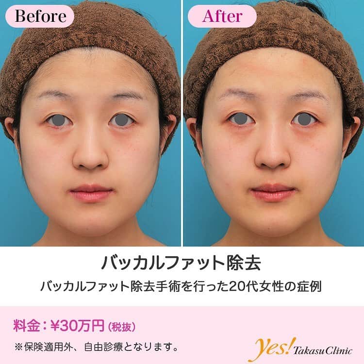 高須クリニックのインスタグラム：「👨🏻‍⚕️高須幹弥医師からのコメント✨⠀ 20代女性の患者様で、バッカルファット除去手術を希望されていました。 診察させていただいたところ、顔の下半分、特に頬に脂肪がたくさんついていました。 皮下脂肪がたくさんついていたのですが、バッカルファットも発達していると思われたため、まずは患者様のご要望通りバッカルファット除去手術をすることになりました。 口の中から左右の頬のバッカルファットを卵の黄身一つ分くらいずつ除去しました。 手術後は頬の膨らみが少し解消し、やや小顔になりました。 今後、脂肪溶解注射などで皮下脂肪の量を減らすと更に小顔になってすっきりすることが期待できます。 ---------------------------------------------------- 🌈料金✨⠀ ●バッカルファット除去 ¥300,000 【東京、横浜、名古屋、大阪】 ---------------------------------------------------- ⚠️リスク・副作用・合併症✨⠀ ●バッカルファット除去 手術後に処方する抗生剤や痛みどめによるアレルギー症状 --------------------------------------------------- 😊施術についての詳細✨⠀⠀ https://www.takasu.co.jp/photo/buccalfat021.html ---------------------------------------------------- 📞ご予約・お問い合わせ✨⠀ 0120-5587-10⠀ https://www.takasu.co.jp/cgi-bin/form/contact.cgi ※症例写真や施術に関するご質問なども上記までお願い致します。 ---------------------------------------------------- #バッカルファット #バッカルファット除去 #頬の膨らみ #小顔  #皮膚 #美容 #美肌 #エイジングケア #美容整形 #美容外科 #美容クリニック #美容好き #美容皮膚科 #モニター #モニター募集 #高須クリニック #高須クリニック名古屋 #高須幹弥 #整形したい #プチ整形 #症例 #症例写真 #可愛くなりたい #可愛い #美人」
