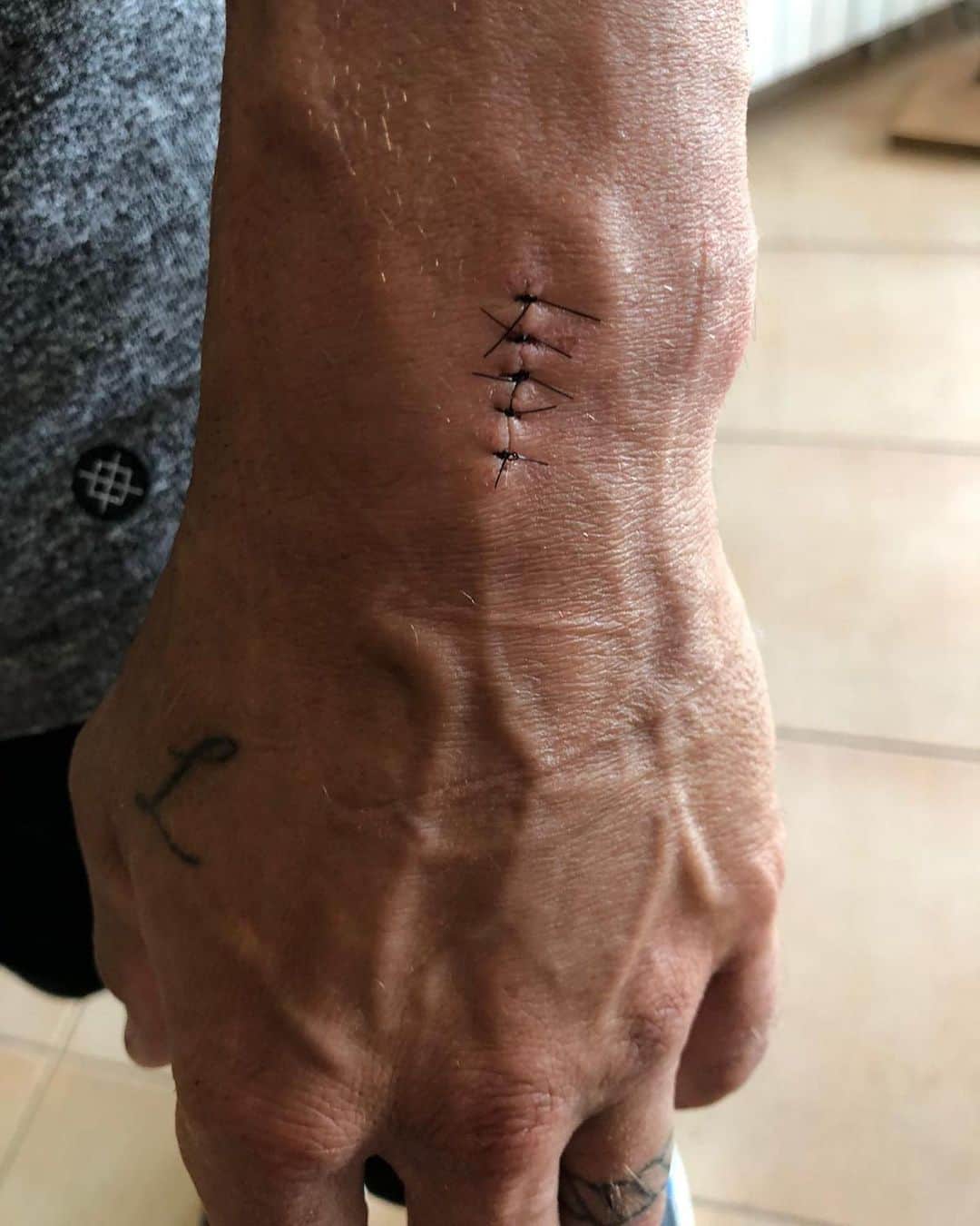 カル・クラッチローのインスタグラム：「Thanks to Dr. Mir that yesterday performed surgery on my scaphoid that went well. I appreciate all the messages and feel well. Will try and give it a go on Friday 👍🏼👊🏼」