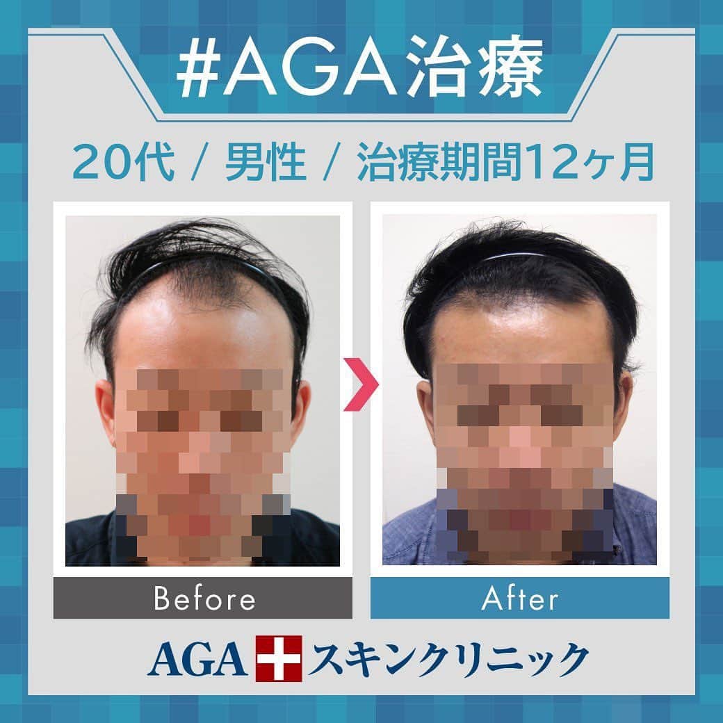 【公式】AGAスキンクリニックさんのインスタグラム写真 - (【公式】AGAスキンクリニックInstagram)「⭐️AGAスキンクリニック　Before⇒After⭐️ . 〇20代男性のケース 〇治療期間12か月 〇内容 ⇒オリジナル発毛薬 ⇒Dr'sメソ治療（AGA メソセラピー） . 生え際の角度が大きく改善しました🎊  発毛治療を始めるのに早すぎることも遅すぎることもありません🐵 まずは無料カウンセリングでご相談ください☺ . . クリニックなど詳細は、@aga_clinic より公式HPをチェックしてみてください🥰 . . #AGAスキンクリニック #AGA #薄毛 #抜毛 #発毛 #育毛 #治療 #薬 #ミノキシジル #ヘアー #AGAスキンクリニック症例 #AGA治療 #男性ホルモン #フィナステリド #M字 #てっぺん #円形 #梅雨対策髪 #梅雨対策ヘアー」6月30日 17時44分 - aga_clinic