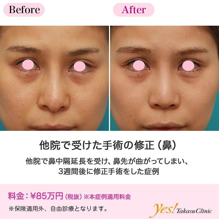 高須クリニックのインスタグラム：「👨🏻‍⚕️高須幹弥医師からのコメント✨⠀ 20代女性の患者様で、3週間前に他院で鼻中隔延長手術を受けていました。 診察させていただいたところ、正面から見ると、鼻先~鼻柱が下に垂れ下がるように延長されていて不自然な上に、鼻先が右に曲がっていました。 横から見ると、鼻先と鼻柱が下に垂れ下がっていることにより、意地悪そうな印象の魔女鼻のようになっていました。 また、鼻柱が下に垂れ下がっていることにより、鼻柱の鼻の穴の中の部分が丸見えになっていました。 こんな鼻では人に会うの嫌だし、外に出るのも嫌ということであったので、まずは可及的に移植した軟骨を除去し、可能な限り元に戻すことになりました。 前回の手術はオープン法で行ってあったので、局所麻酔下に、鼻柱と両側の鼻の穴の中を切開し、再びオープンして、全体像が見えるように展開しました。 鼻中隔軟骨と耳介軟骨を組み合わせて鼻中隔延長をしていたようであり、移植してあったそれらの軟骨を可能な限り除去しました。 前回の手術から3週間経過していたため、多少の癒着はありましたが、ほぼ全ての移植してあった軟骨を除去することができました。 可能な限り自然な鼻を復元するため、尖端のみ大鼻翼軟骨の軟骨間縫合を行い、組織が欠損して足りない部分には、除去した軟骨を砕片して、充填するように移植しました。 術後は、鼻先の曲がりはほぼ改善し、不自然で意地悪そうな魔女鼻の印象も改善し、自然でバランスが良く、この患者様の顔に合った鼻になりました。 鼻中隔延長をして、状態が良くない場合、気に入っていない場合、曲がっている場合、元に戻したい場合などは、移植した軟骨が癒着する前に修正手術することが良いことがあります。 3週間以内であれば、移植した軟骨をほぼ除去することができます。 それ以上経過すると、移植した軟骨が癒着しており、完全に除去できないことが多いです。 ---------------------------------------------------- 🌈料金✨⠀ ●他院で受けた手術の修正（鼻） （本症例適用料金） ¥850,000【東京、横浜、名古屋、大阪】 ※診察にてご確認ください ---------------------------------------------------- ⚠️リスク・副作用・合併症✨⠀ ●他院で受けた手術の修正（鼻） 手術後に処方する抗生剤や痛みどめによるアレルギー症状 --------------------------------------------------- 😊施術についての詳細✨⠀⠀ https://www.takasu.co.jp/photo/nose_modify017.html ---------------------------------------------------- 📞ご予約・お問い合わせ✨⠀ 0120-5587-10⠀ https://www.takasu.co.jp/cgi-bin/form/contact.cgi ※症例写真や施術に関するご質問なども上記までお願い致します。 ---------------------------------------------------- #他院で受けた手術の修正 #鼻中隔延長 #修正手術 #鼻整形 #魔女鼻 #鼻先の曲がりを改善  #皮膚 #美容 #美肌 #エイジングケア #美容整形 #美容外科 #美容クリニック #美容好き #美容皮膚科 #モニター #モニター募集 #高須クリニック #高須クリニック名古屋 #高須幹弥 #整形したい #プチ整形 #症例 #症例写真 #可愛くなりたい #可愛い #美人」
