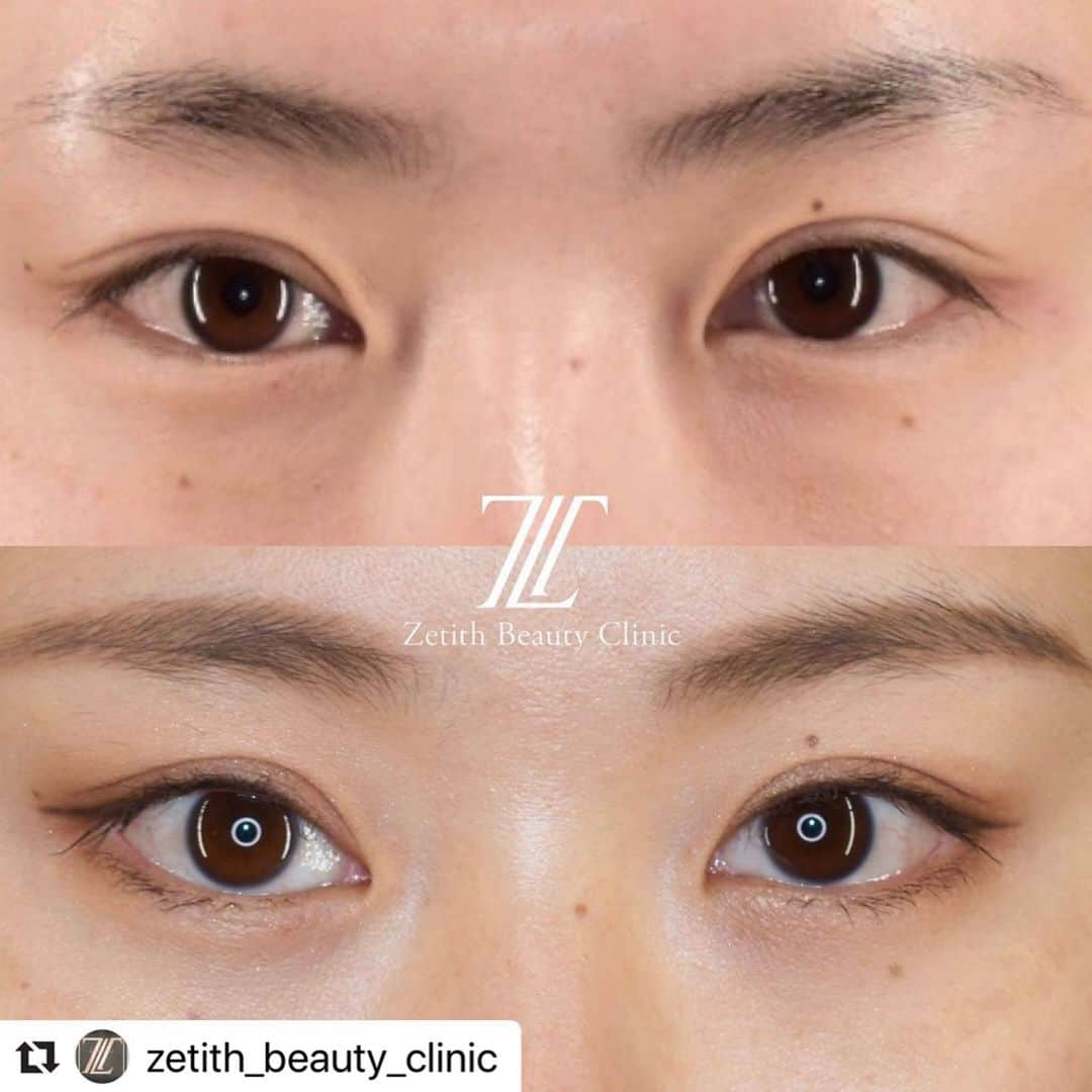 黒田愛美さんのインスタグラム写真 - (黒田愛美Instagram)「#Repost @zetith_beauty_clinic with @make_repost ・・・ DMにより他院の同様の治療内容で70万円から100円以上の見積もりを多くいただいております。﻿ ゼティスは完全口コミ、インスタグラマーさんの宣伝費や広告費を0円でやっているため、その分をお客様に還元しております！！﻿ 予約殺到中のクマトリ﻿ ﻿ 目の下のクマは実年齢より上に見えてしまう原因のひとつです😢﻿ ﻿ ﻿ 鏡を見てみてください﻿ ☑︎目の下に線がある﻿ ☑︎目の下に膨らみがある﻿ ☑︎目の下に黒っぽいクマがある﻿ ☑︎疲れてる？と周りに言われる﻿ ﻿ １つでも該当箇所がある方は﻿ クマ治療の適応になります﻿ ﻿ Zethith Beauty Clinicで提案する最上級治療は目の下の膨らみを取るだけではありません🙅‍♀️﻿ ﻿ ①老け顔の原因となるたるみを除去﻿ ② 目の下の凹みの改善＋ハリ艶を出す為にマイクロナノリッチ脂肪を注入﻿ ③ 手術では改善の難しい小じわを撃退しつつ、脂肪の定着率を上げるために高濃度PRPの注射﻿ ﻿ この3点を組み合わせた治療をおすすめしております﻿ ﻿ ﻿ 膨らんではいけない所を凹ませ、﻿ 凹んでいけない所を膨らませ、﻿ 最後に小じわを改善し、定着率もアップ﻿ ﻿ ﻿ このメニューを他院で受けると、﻿ 100万近くになる事もある内容です🤫💡﻿ 一切これ以上になるアップセルは致しません🙋🏻‍♀️﻿ ﻿ ﻿ まずはお気軽にカウンセリングにお越しください❤️﻿ ﻿ ﻿ 💰金額:﻿ 通常価格50万(税別)﻿ モニター価格35万(税別)﻿ 😷ダウンタイム:﻿ 腫れ、内出血、ボコつき、左右差﻿ 個人差がございますが2週間前後でる場合がございます。﻿ 📍Zetith beauty clinic .﻿ (ゼティス ビューティー クリニック).﻿ 東京都中央区銀座4丁目2-17 111レジャービル13階﻿ ﻿ ⏰:10時〜19時（年末年始を除いて年中無休）﻿ ☎:03-6271-0977 ﻿ ﻿ ﻿ #zetithbeautyclinic#cosmeticsurgery#plasticsurgery#ゼティスビューティークリニック#美容外科#美容皮膚科#美容外科医#美容皮膚科医#女医#美容整形#プチ整形#整形#整形垢#二重整形#目頭切開#埋没法#グラマラスライン#切らない目の下のたるみ取り#脂肪注入#ゴルゴ線#アンチエイジング」7月1日 17時34分 - kurodaaimi