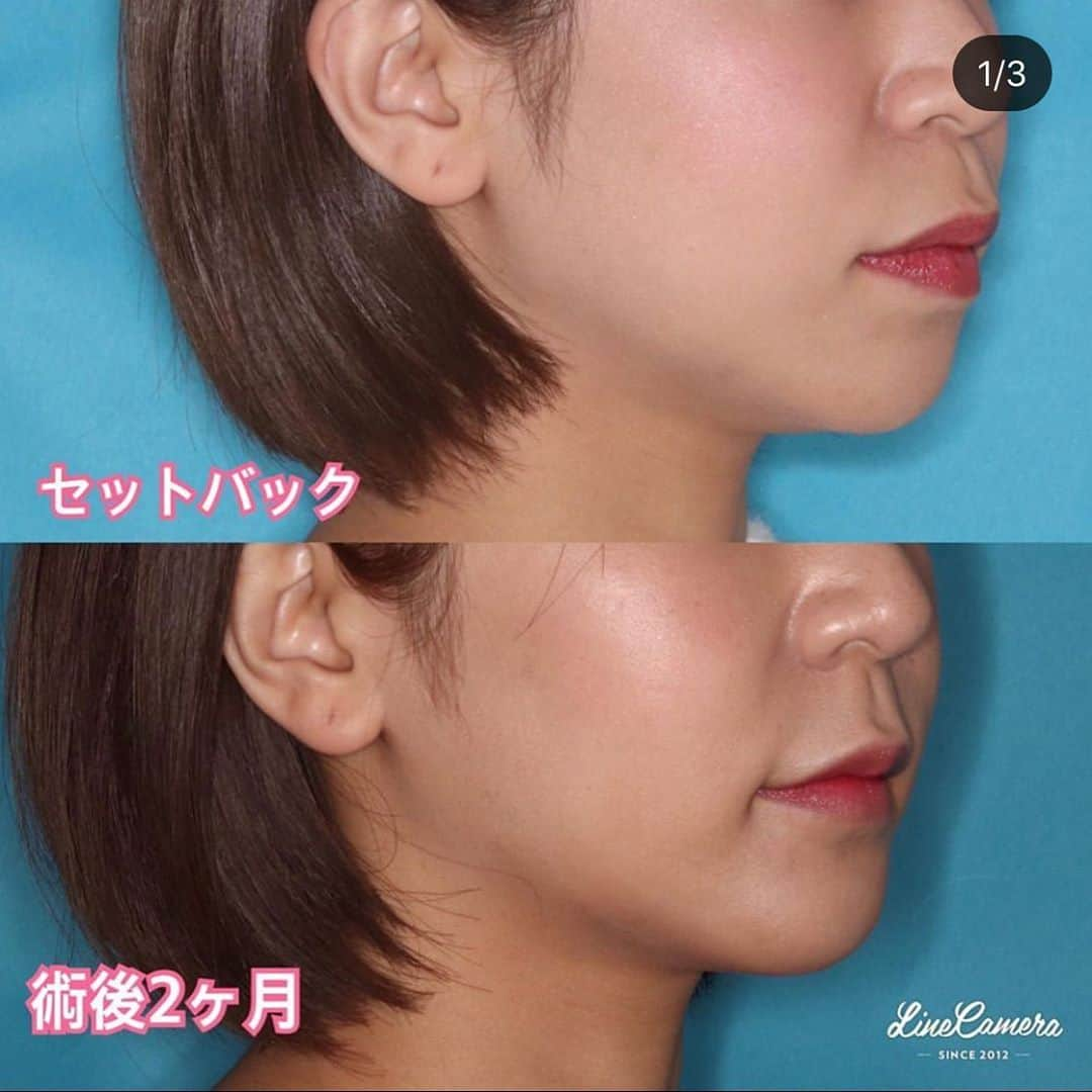 ミライ美デザイン｜大塚美容形成外科・歯科のインスタグラム：「@otsukabiyo_dental より セットバック術後2ヶ月です🦷❣️ 顎のラインがしっかり出てきて横顔がスッキリ見えるようになりました🥰😘🥰 当院ではトリビューにて#オンラインカウンセリング　を行っております😊ぜひお試し下さい❤️ Instagramに質問、コメントお待ちしております😘  #セラミスト#セットバック#口元#口もと#上下#Eライン#顎がない#オトガイ形成術#ゴボ#保坂太一#歯並び#横顔　#常勤麻酔科医　#安心の入院施設　#骨切り　#大塚美容形成外科#モニター募集　#カウンセリング無料#上下骨切り#歯　#痛みのない治療#トリビュー#セラミック#ジルコニア#3泊4日美人#ＢＰＳ#義歯　#入れ歯」