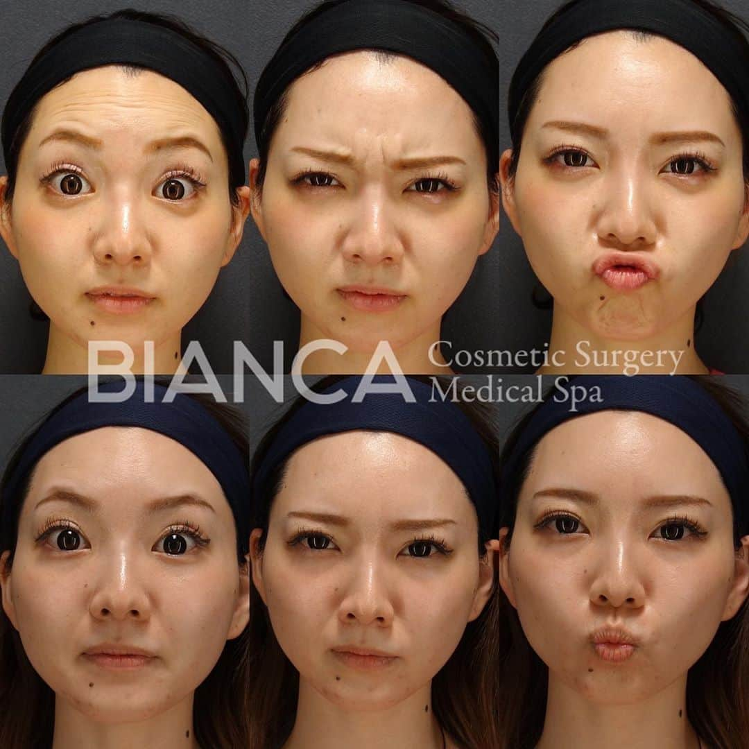 辻沢由有（BIANCA CLNIC 表参道院 院長）さんのインスタグラム写真 - (辻沢由有（BIANCA CLNIC 表参道院 院長）Instagram)「【ボトックスは一気にメンテナンス💉】﻿ ﻿ 気になるシワは一度に治療してあげると、次回のメンテナンスの時期もわかりやすいのでオススメです🥰﻿ ﻿ 上 注入前﻿ 下 注入2週間後﻿ ﻿ ボトックスは、正しい診断と治療が大事👩‍⚕️‼️﻿ ご検討中の方、是非一度カウンセリングに﻿ お越しください😘﻿ ﻿ 🌸額ボトックス💉Botox Vista 8単位.﻿ 🌸眉間ボトックス💉Botox Vista 6単位.﻿ 🌸顎ボトックス💉Botox Vista 10単位.﻿ ﻿ 💴製剤料 600円/単位﻿ 別途 ボトックス施術料 20,000円﻿ ⏳治療時間: 5分﻿ 🗓持続期間: 4〜6ヶ月﻿ 😷腫れ・内出血: 数日程度﻿ ﻿ ﻿ ⚠️ご予約の際は﻿ 『Dr Yuu（辻沢）のインスタ見た』の一言をお願いします👩‍⚕️✨﻿ ﻿ 📍BIANCA CLINIC﻿ ✔︎表参道院﻿ 03-6433-5994﻿ 東京都港区南青山5-11-10  南青山511ビル 2F﻿ ✔︎銀座院﻿ 03-6263-2690 ﻿ 東京都中央区銀座1-5-6 銀座レンガ通り福神ビル 4F﻿ 診療時間 10:00〜19:00﻿ 年中無休（年末年始を除く）﻿  ﻿ 7月勤務日🌻 表参道院 ↪︎1 5 10 12 15 19 20 26 27 28 30 銀座院 ↪︎2 4 6 7 11 16 17 21 22 25 ﻿ #美容好き#プチ整形#botoxcapilar #美容好きな人と繋がりたい#美容垢#綺麗になりたい #美容皮膚科 #美容外科 #cosmeticsurgery #plasticsurgery #biancaclinic #ビアンカクリニック #プレ花嫁さんと繋がりたい #followｍe #フォローミー #銀座 #女医 #モニター募集  #dryuuボト#botox #眉間ボトックス #ダイエット #額ボトックス #プチ整形  #イメージチェンジ #ボトックス #ひたいボトックス #女医 #顎ボトックス #目尻ボトックス」7月2日 18時54分 - i_am_yuu__