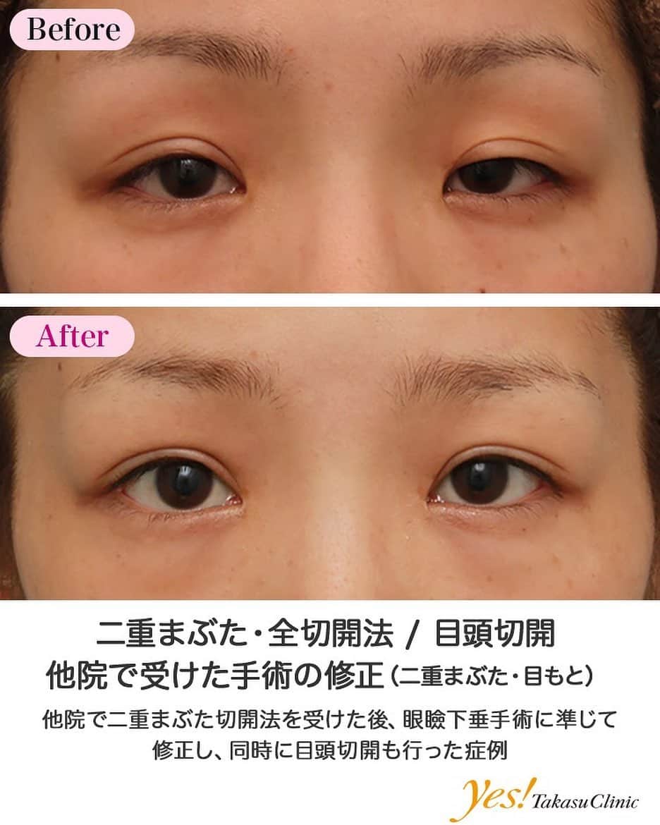 高須クリニックのインスタグラム：「👨🏻‍⚕️高須幹弥医師からのコメント✨⠀ 20代女性の患者様で、6ヶ月以上前に他院で二重まぶた切開法を受けており、修正手術希望で来院されました。 診察させていただいたところ、まぶたを開ける力に左右差があり、それによって、目を開けた状態での二重の幅に左右差がありました。 この眼瞼下垂の原因が、先天性のものなのか、通常の腱膜性のものなのか、前回の他院での手術からの医原性のものなのかははっきりとしませんでしたが、これを治さなければ非対称は治らない状態でした。 手術は、二重まぶた全切開法に準じ、前回の他院での切開線を切除し、アプローチしました。 また患者様は、目頭切開もしたいというご要望だったので、同時に行うことになりました。 二重のラインから内部を展開し、瞼板の上端を露出し、挙筋腱膜の断端と縫合したところ、開瞼が改善したため、左右均等に開瞼するように調節しました。 瞼板と挙筋腱膜を縫合した部位を拾って皮膚縫合し、新たに二重のラインを作り直しました。 目頭切開はキツい寄り目にならない程度に約1.5mmずつZ法で内側に目を広げました。 術後は二重の幅の左右差が改善し、全体的に目が大きくなり、修正前よりはっきりとした印象の目になりました。 ---------------------------------------------------- 🌈料金✨⠀ ●二重まぶた・全切開法 片目 ¥135,000 / 両目 ¥250,000【東京、横浜、名古屋、大阪】 脂肪切除をする場合や埋没法の糸を抜去する場合の費用も含まれております。 ●目頭切開 片目 ¥135,000 / 両目 ¥250,000【東京、横浜、名古屋、大阪】 ---------------------------------------------------- ⚠️リスク・副作用・合併症✨⠀ ●二重まぶた・全切開法 まぶたの強い腫れ（術後／個人差があります） 内出血（術後） 仕上がりの左右差（片目ずつ手術をする場合） 不自然な二重（無理に二重の幅を広げた場合） 仕上がりのわずかな左右差（完璧なシンメトリーは不可） 仕上がりが完璧に自分の理想の形にならないことがある 二重のラインの癒着がとれる可能性 手術後の血腫 ●目頭切開 内出血（術後） 仕上がりの左右差（片目ずつ手術をする場合） 仕上がりのわずかな左右差（完璧なシンメトリーは不可） 仕上がりが完璧に自分の理想の形にならないことがある --------------------------------------------------- 😊施術についての詳細✨⠀⠀ https://www.takasu.co.jp/photo/sekkai047.html ---------------------------------------------------- 📞ご予約・お問い合わせ✨⠀ 0120-5587-10⠀ https://www.takasu.co.jp/cgi-bin/form/contact.cgi ※症例写真や施術に関するご質問なども上記までお願い致します。 ---------------------------------------------------- #二重まぶた #全切開法 #切開法 #目頭切開 #二重整形 #他院で受けた手術の修正  #皮膚 #美容 #美肌 #エイジングケア #美容整形 #美容外科 #美容クリニック #美容好き #美容皮膚科 #モニター #モニター募集 #高須クリニック #高須クリニック名古屋 #高須幹弥 #整形したい #プチ整形 #症例 #症例写真 #可愛くなりたい #可愛い #美人」