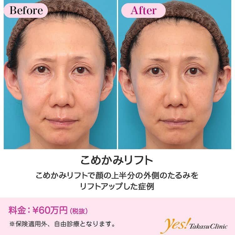 高須クリニックのインスタグラム：「👨🏻‍⚕️高須幹弥医師からのコメント✨⠀ 40代女性の患者様で、こめかみのリフトアップご希望で来院されました。 この患者様は数年前に私がミディアムフェイスリフトをしており、そのときは顔の下半分を中心にリフトアップしていて、その効果は十分に持続していました。 ミディアムフェイスリフトでもわずかにこめかみはリフトアップされるのですが、あくまで顔の下半分を中心にリフトアップさせるのが目的の手術であるため、効果が不十分でした。 今回は、こめかみや目尻のたるみをしっかりと外側上方にリフトアップしたいということでしたので、こめかみリフト手術をすることになりました。 局所麻酔下に、両側のこめかみの頭髪内を約6cmずつ皮膚切開し、浅側頭筋膜も切開し、側頭筋の固有筋膜を露出させました。 浅側頭筋膜と側頭筋の固有筋膜の間を、目尻まで指で鈍的に剥離した後、浅側頭筋膜同士を縫縮し、リフトアップしました。 皮膚の切除は行わず、皮膚を丁寧に縫合しました。 術後は、ほどよくこめかみや目尻のたるみが上がりました。 また、こめかみがリフトアップされることにより、頬のたるみも少しリフトアップされました。 こめかみと頬は一枚の皮膚で繋がっているため、こめかみがリフトアップされると、つられて頬も少しリフトアップされます。 ---------------------------------------------------- 🌈料金✨⠀ ●こめかみリフト ¥600,000【東京、横浜、名古屋、大阪】 ---------------------------------------------------- ⚠️リスク・副作用・合併症✨⠀ ●こめかみリフト 側頭部の傷跡の一時的な盛り上がり（術後／効果に影響はありません） 仕上がりのわずかな左右差（完璧なシンメトリーは不可） 感覚が鈍くなる可能性 手術後の血腫 --------------------------------------------------- 😊施術についての詳細✨⠀⠀ https://www.takasu.co.jp/photo/komekamilift002.html ---------------------------------------------------- 📞ご予約・お問い合わせ✨⠀ 0120-5587-10⠀ https://www.takasu.co.jp/cgi-bin/form/contact.cgi ※症例写真や施術に関するご質問なども上記までお願い致します。 ---------------------------------------------------- #こめかみリフト #リフトアップ #こめかみのリフトアップ #頬のリフトアップ #頬のたるみ #目尻のたるみ  #皮膚 #美容 #美肌 #エイジングケア #美容整形 #美容外科 #美容クリニック #美容好き #美容皮膚科 #モニター #モニター募集 #高須クリニック #高須クリニック名古屋 #高須幹弥 #整形したい #プチ整形 #症例 #症例写真 #可愛くなりたい #可愛い #美人」