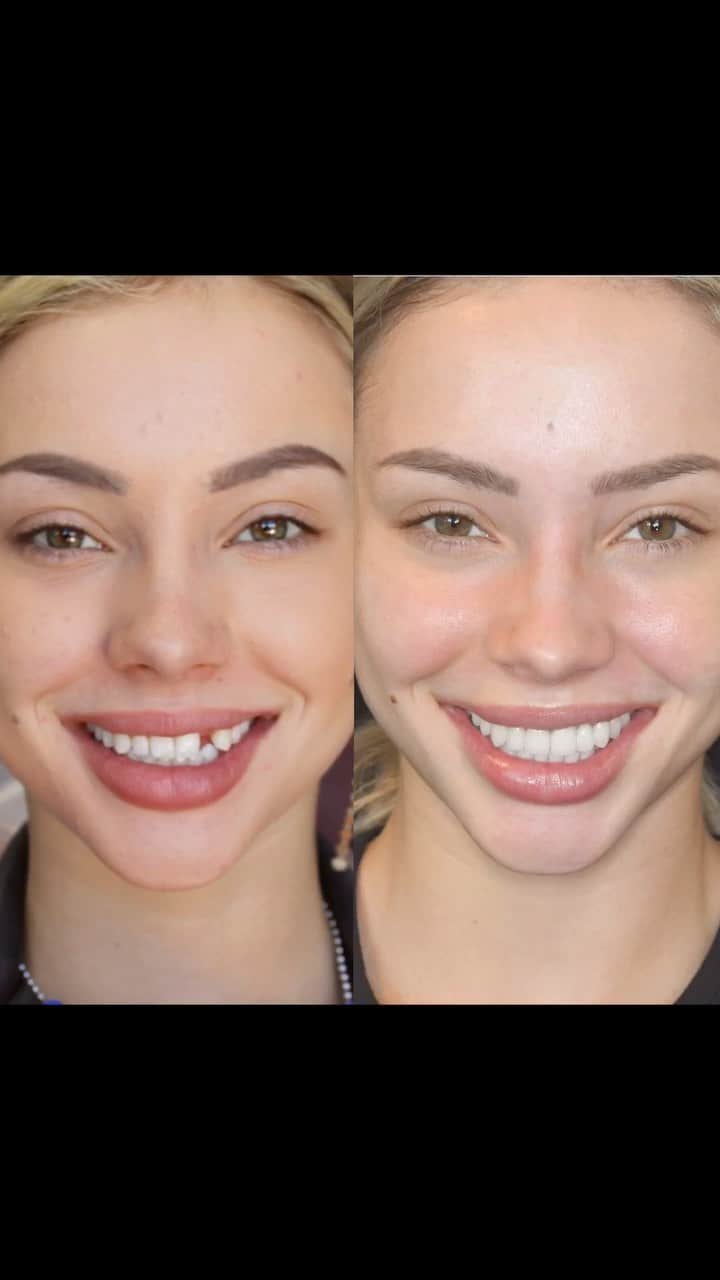 チャーリー・ジョーダンのインスタグラム：「I’m gonna miss the tooth jokes but it was time! I loved my missing tooth but my retainer was starting to wear down my other teeth and cause cavities so we found a healthier, more permanent solution. I hope you guys enjoy this video, I really enjoyed making it. Thank you so much again @drgaberosenthal !」