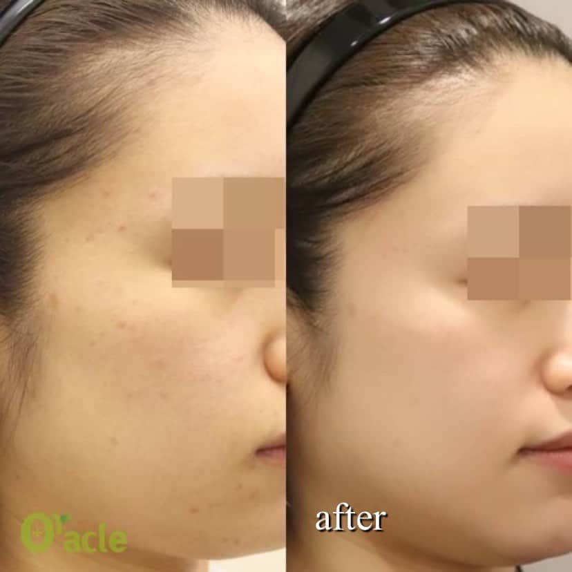 オラクル美容皮膚科東京新宿院さんのインスタグラム写真 - (オラクル美容皮膚科東京新宿院Instagram)「アクアピーリングを毎月﻿ 2年以上継続。﻿ ニキビができにくくなり、美肌をキープ👏﻿ ﻿ よく1回で治りますか？﻿ と質問をいただきます。﻿ 即時効果のある施術もありますが、﻿ 特に繰り返すニキビ肌の方は1回で劇的に改善できる！ということは残念ながらありません😔﻿ ﻿ まずはニキビを改善﻿ さらにキープする治療﻿ そしてくすみのない肌質に整え﻿ お肌を綺麗にしていく﻿ ﻿ 継続は美肌なり！です💚﻿ ﻿ ﻿ アクアピーリングは…﻿ 韓国では定番中の定番﻿ 毛穴の汚れや古い角質を取る施術﻿ ﻿ 韓国ではアクアピーリングだけやるというより、他の施術とパッケージになっていることが多いですよね🇰🇷﻿ ﻿ 韓国での相場は3000円〜5000円くらい⁈﻿ 日本は1万円くらいなので韓国よりは料金は高くなってしまいますね😅﻿ ﻿ オラクルでは1回　11,000円﻿ コースにするともう少しお安くなります。﻿ ﻿ オラクルでもレーザー治療や水光注射とセットで施術する方が多いです。👌﻿ ﻿ 【効果】﻿ ニキビ﻿ 顔ダニ減少﻿ 美白﻿ キメ改善﻿ 角質除去﻿ 水分補給﻿ 皮脂除去﻿ 鼻の黒ずみ﻿ 皮脂詰まり﻿ ﻿ ⚠️リスクなど﻿ 赤みが出る方がいますが、一時的なものでその日のうちに治ることがほとんどです。﻿ 施術中ピリピリ感を感じる場合がありますが、痛くて耐えられないほどではありません。﻿ ﻿ 比較的手軽に始められるアクアピーリング﻿ マスクで蒸れてベタベタしている方にもおすすめです！﻿ ﻿ ▪️▫️▪️▫️▪️▫️▪️▫️▪️▫️﻿ ﻿ 🇯🇵オラクル美容皮膚科🇰🇷﻿ 📍新宿3丁目19-4 MLJ新宿8階﻿ ﻿ 【専門】﻿ ニキビ（跡）／毛穴／シミ／しわ／たるみ／痩身／アンチエイジング／美白美肌全般／ブライダル相談／メンズ美容﻿ ﻿ 🗝完全予約制﻿ 👠土日祝日も診療﻿ ﻿ 【予約方法】﻿ ☎0120-905-696﻿ ⏰9:00～21:00［年中無休］﻿ ﻿ LINE、メール24時間📧﻿ LINE🆔 @oracle.jp ﻿ 📩HPメールフォームよりお願いいたします﻿ ﻿ ▪️▫️▪️▫️▪️▫️▪️▫️▪️▫️﻿ #オラクル美容皮膚科 #オラクル ﻿ #oracle #美容皮膚科 ﻿ #メディカルエステ #皮膚管理 ﻿ #美容 #美容皮膚科 #ブラックヘッド ﻿ #AQUA #美白 #미용피부과 #물광피부 #미백 ﻿ #アクアピーリング #ハイドラフェイシャル﻿ #毛穴洗浄﻿ #オラクル美容皮膚科 #오라클피부과  #毛穴ケア #美肌 #ピーリング #毛穴 #保湿  #韓国美容  #角質 #美肌男子 #メンズ美容 #美意識高い人と繋がりたい」7月4日 11時16分 - oraclejp