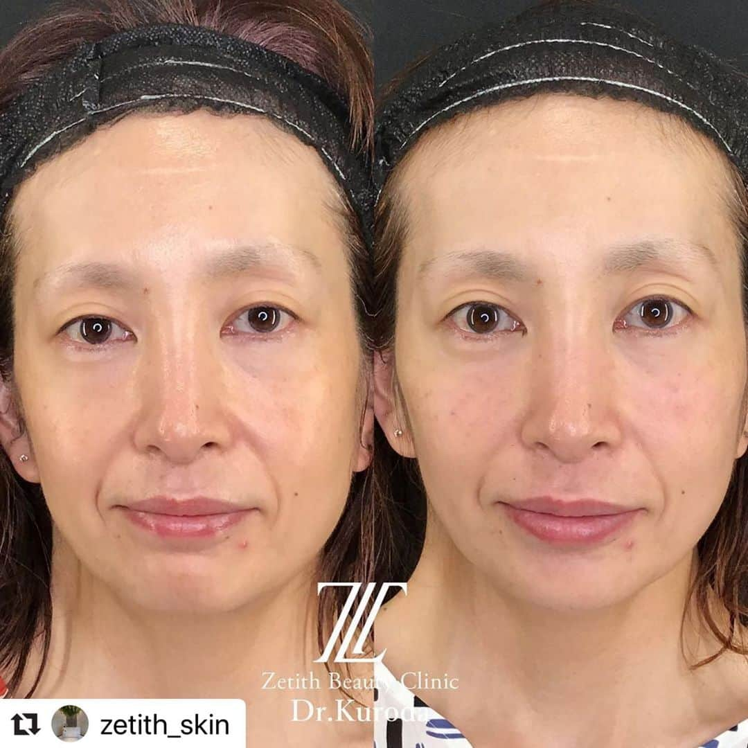 黒田愛美さんのインスタグラム写真 - (黒田愛美Instagram)「#Repost @zetith_skin with @make_repost ・・・ #ヒアルロン酸リフト 💉﻿ ヒアルロン酸で﻿ #目の開き も改善するの﻿ ご存知ですか❓﻿ 左はbefore ﻿ 右は直後です✨﻿ 目がだいぶぱっちりしましたね👀﻿ #目の下 #頬 #唇 なども﻿ 全体的に若くなりましたね❤️﻿ #zetithbeautyclinic #cosmeticsurgery #plasticsurgery ﻿ #ゼティスビューティークリニック ﻿ #たるみ #小顔 #フェイスライン﻿ #ヒアルロン酸﻿ #リフトアップ ﻿ #たるみ治療﻿ #たるみ改善﻿ #小顔治療﻿ #フェイスラインスッキリ ﻿ #ヒアルロン酸リフト﻿ #ヒアルロン酸によるリフトアップ﻿ #認定注入指導医﻿ #ヒアルロン酸注入講師﻿ #美容アンチエイジング専門医﻿ #黒田愛美」7月4日 15時43分 - kurodaaimi