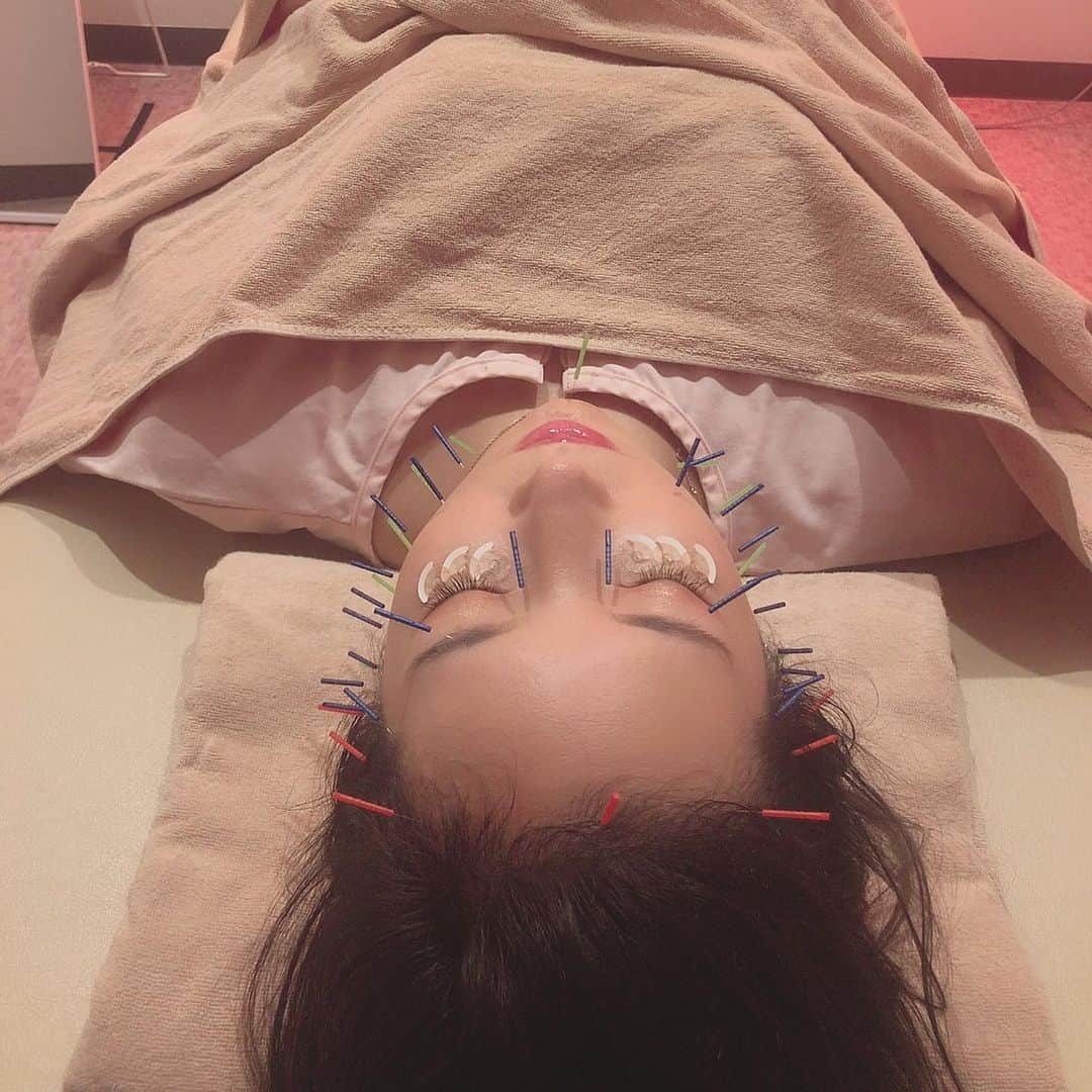 早川瀬里奈のインスタグラム：「経絡美容鍼してきた🥰 見た目凄いけど全然痛くないし、整形級に目の開き良くなって嬉しい😂 世田谷ビューティークリニックは化粧したまま鍼やって貰えるから次の予定組みやすくて助かる！前行ってた美容鍼のクリニックはすっぴんで行かなくちゃいけなくて、それが原因で足が遠のいたから💦 やっぱ鍼即効性あるよね〜改めて感動✨ お灸でお腹もあっためて貰ったからじんわりポカポカ♨️ 冷えとむくみももっと改善していきたいから今度は経絡鍼灸治療もやりたいなと思ってる🌟  @sbc.tokyo  #世田谷ビューティークリニーク #池尻大橋エステ #世田谷エステ #美容鍼 #経絡美容鍼#pr#コラボベース#リフトアップ#むくみ改善 #くすみケア #目の開きが普段の3倍以上」