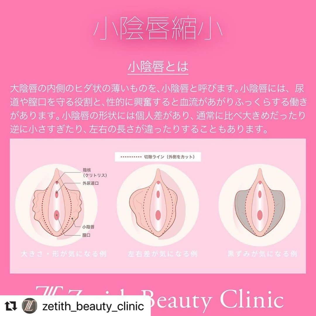 黒田愛美さんのインスタグラム写真 - (黒田愛美Instagram)「#Repost @zetith_beauty_clinic with @make_repost ・・・ 【婦人科形成術】﻿ ﻿ 沢山の方に大満足して頂いてるので婦人科形の特別モニター期間を伸ばさせて頂きます🙋🏻‍♀️﻿ ﻿ 小陰唇縮小術と副皮除去術と大陰唇縮小術﻿ ﻿﻿ ﻿ Zetith Beauty Clinicの婦人科形成術では、吸収する糸を使用し粘膜下と表面を丁寧に縫い合わせます。吸収される糸を使用している為抜糸も不要です✨ 術後も安心。😌﻿ 抜糸がないため痛くない、通院の必要ない、傷も綺麗に治るというメリットがあります🌟😲﻿ ※糸が気になる方は抜糸しても大丈夫です!!﻿ 糸で縫うからこそ、傷がしっかり綺麗に治ります🌸﻿ ﻿ ﻿ 🌹 ー婦人科形成術ー﻿ ﻿ 💴 小陰唇縮小術 ￥200,000 (麻酔代5万円別)﻿  モニター価格 ￥189,000(麻酔代込)﻿ ﻿ 💴小陰唇縮小術+副皮除去術 ￥400,000(麻酔代5万円別)﻿  モニター価格 ￥289,000(麻酔代込)﻿ ﻿ ﻿ ※モニター価格は人数制限がございます。気になる方は電話でお問い合わせ下さいませ。﻿ ﻿ 😷ダウンタイム：個人差はございますが、腫れ・内出血2週間前後﻿ 🌡麻酔：静脈麻酔﻿ .﻿ 📍Zetith beauty clinic (ゼティス ビューティー クリニック)﻿ ☎電話：03-6271-0977 .﻿ 💻ネット：https://zetithbeautyclinic.com﻿ ﻿ ﻿ ﻿ ﻿ #zetithbeautyclinic﻿ #ゼティスビューティークリニック ﻿ #ハイフ﻿ #美肌﻿ #婦人科形成 ﻿ #小陰唇縮小術 ﻿ #小陰唇縮小 ﻿ #デリケートゾーンの黒ずみ ﻿ #デリケートゾーンの悩み ﻿ #デリケートゾーンのかゆみ ﻿ #デリケートゾーン ﻿ #大陰唇 ﻿ #副皮除去術 ﻿ #黒ずみ ﻿ #若返り ﻿ #膣トレ ﻿ #美容﻿ #婦人科﻿ #エイジングケア﻿ #たるみ改善 ﻿ #美人 ﻿ #鼻先 ﻿ #鼻でか ﻿ #埋没法 ﻿ #小顔﻿ #美魔女﻿」7月6日 18時22分 - kurodaaimi