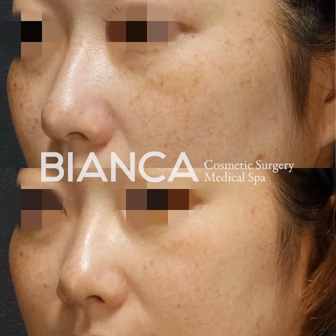 辻沢由有（BIANCA CLNIC 表参道院 院長）さんのインスタグラム写真 - (辻沢由有（BIANCA CLNIC 表参道院 院長）Instagram)「【ピコスポット照射1回後の経過🌟】﻿ ﻿ 上 治療前﻿ 下 スポット照射後﻿ ﻿ 残ったシミは、ここからトーニング治療を開始すると﻿、もっと綺麗になっていきます❣️✨✨﻿ ﻿ 色素が改善されるだけでなく 回を重ねるごとに、肌のキメも細やかになってきます🙌❣️﻿ ﻿ 1人で悩んでいる時間はもったいないです❗️😵⭐﻿ 気になる方は是非カウンセリングにお越しください☺️️﻿ ﻿ 💴 ピコスポット 全顔 98,000円﻿ 💉麻酔: 表面麻酔﻿ 😷DT: シミの黒浮き1週間程度﻿ ⚠️リスク: 色素脱失・色素沈着・水泡形成など﻿ 💴ピコトーニング 14,800円/回﻿ ﻿ 🉐モニター募集中‼️ ﻿ ⚠️ご予約の際は﻿ 『Dr Yuu（辻沢）のインスタ見た』の一言をお願いします👩‍⚕️✨﻿ ﻿ 📍BIANCA CLINIC﻿ ✔︎表参道院﻿ 03-6433-5994﻿ 東京都港区南青山5-11-10  南青山511ビル 2F﻿ ✔︎銀座院﻿ 03-6263-2690 ﻿ 東京都中央区銀座1-5-6 銀座レンガ通り福神ビル 4F﻿ ﻿ 診療時間 10:00〜19:00﻿ 年中無休（年末年始を除く）﻿ 🔜﻿ 7月勤務日🌻﻿ 表参道院﻿ ↪︎1 5 10 12 15 19 20 26 27 28 30﻿ 銀座院﻿ ↪︎2 4 6 7 11 16 17 21 22 25﻿ ﻿ #plasticsurgery #cosmeticsurgery  #美容外科 #美容皮膚科 #美容整形 #プチ整形 #美肌 #美魔女 #美容 #アンチエイジング  #picosure #ピコシュア #ピコトーニング #ピコフラクショナル #ビアンカクリニック #dryuu #シミ取り #そばかす #シミ治療 #dryuu肌 #ソバカス #スキンケア #美白 #biancaclinic #ビアンカクリニック #レーザートーニング #モニター募集 #モニター募集中 #followｍe #フォローミー」7月6日 10時48分 - i_am_yuu__