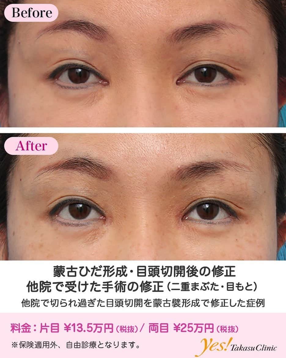 高須クリニックのインスタグラム：「👨🏻‍⚕️高須幹弥医師からのコメント✨⠀ 40代女性の患者様で、他院で受けた目頭切開の修正手術希望で来院されました。 診察させていただいたところ、恐らく、W法（内田法）で目頭切開を受けており、うっすらとWの字型の傷跡が見られました。 かなり皮膚を切除されてしまったようで、蒙古襞が完全になくなっている状態になっており、目頭の形がパンチで穴を開けたような状態で、ぱっくり丸く開いていました。 そのため、涙丘（目頭側の赤い粘膜が盛り上がっている部分）が丸見えになっており、異様な目になっていました。 また、この患者様は、元々、骨格的に眼球の位置が外側についているタイプなのに、目頭切開で、左右の目の横幅と、目と目の間隔を、黄金比率の1:1:1にしたため、両目の黒目が外側に向いている外斜視（いわゆるロンパリ）の状態になっていました。 蒙古襞形成を行い、涙丘を襞で隠し、バランスを整えることになりました。 通常の下向きの蒙古襞を望んではいなかったので、逆Z法ではなく、V-Y法で行いました。 目頭側の上下の皮膚を裏側と表側で縫い合わせ、約1.5mmずつくらい涙丘を隠すようにしました。 術後は程よく涙丘が隠れ、修正手術前のような異様な感じはだいぶ改善されました。 黄金比率にある、「左右の目の横幅と、目と目の間隔が1:1:1が理想」というのは、あくまで、そのようなバランスの人は美しいというものであり、何でもかんでも美容整形手術で1:1:1にすれば良いのではありません。 骨格的な眼球の位置、眼球の大きさ、蒙古襞の張り方などによって、その人の一番良いバランスというのがあるので、数字にとらわれず、1:1:1に拘らないことが重要です。 ---------------------------------------------------- 🌈料金✨⠀ ●蒙古ひだ形成・目頭切開後の修正 片目 ¥135,000 / 両目 ¥250,000【東京、横浜、名古屋、大阪】 ---------------------------------------------------- ⚠️リスク・副作用・合併症✨⠀ ●蒙古ひだ（蒙古襞）形成・目頭切開後の修正 内出血（術後） 仕上がりのわずかな左右差（完璧なシンメトリーは不可） 仕上がりが完璧に自分の理想の形にならないことがある --------------------------------------------------- 😊施術についての詳細✨⠀⠀ https://www.takasu.co.jp/photo/hida007.html ---------------------------------------------------- 📞ご予約・お問い合わせ✨⠀ 0120-5587-10⠀ https://www.takasu.co.jp/cgi-bin/form/contact.cgi ※症例写真や施術に関するご質問なども上記までお願い致します。 ---------------------------------------------------- #蒙古ひだ形成 #目頭切開後の修正 #蒙古ひだ #目頭切開 #他院で受けた手術の修正  #皮膚 #美容 #美肌 #エイジングケア #美容整形 #美容外科 #美容クリニック #美容好き #美容皮膚科 #モニター #モニター募集 #高須クリニック #高須クリニック名古屋 #高須幹弥 #整形したい #プチ整形 #症例 #症例写真 #可愛くなりたい #可愛い #美人」