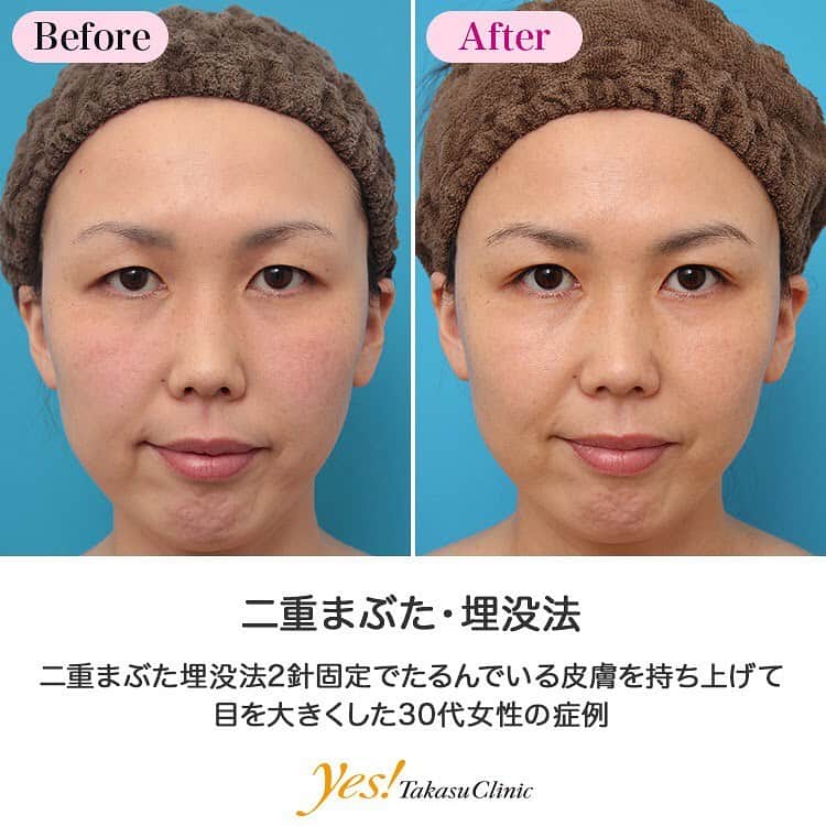 高須クリニックのインスタグラム：「👨🏻‍⚕️高須幹弥医師からのコメント✨⠀ 30代後半の女性患者様で、目のご相談で来院されました。 上まぶたの外側の皮膚が被さって、三角形の目になっているのを気にされていました。 診察させていただいたところ、奥二重のラインが非常に狭い位置にあるのですが、たるんだ皮膚が覆い被さり、二重のラインは完全に見えなくなっている状態でした。 患者様は、「あまり印象が変わり過ぎないように、まぶたのたるみを改善して、ぱっとした明るい印象になりたい」 というご要望でした。 となると、まぶたの皮膚が余っているので、上眼瞼リフトで、眉毛の下の分厚い部分で上まぶたの皮膚の被さりを取り、二重まぶた全切開法で狭い二重を作るのが最善だと考えられます。 しかし、患者様は、「まずは切らない治療でやりたい」というご要望でしたので、まずは二重まぶた埋没法をすることになりました。 まぶたの被さりが多いので、綺麗に目頭側から目尻側までたるみが上がるように、2針固定で行いました。 術後は、全体的にまぶたの皮膚の被さりが上がって、目が大きくなり、目尻側だけわずかに二重の幅が見える、ほぼ奥二重になりました。 三角形の老けた印象の目が、目もとがはっきりした丸い目になりました。 この患者様のように切らないでまぶたのたるみを改善したい場合、二重まぶた埋没法2針固定が有効になることもあります。 ---------------------------------------------------- 🌈料金✨⠀ ●二重まぶた・埋没法 片目 ¥50,000 / 両目 ¥90,000【全院】 ●二重まぶた・埋没法（二針固定） 片目 ¥90,000 / 両目 ¥170,000【東京、横浜、名古屋、大阪】 ---------------------------------------------------- ⚠️リスク・副作用・合併症✨⠀ ●二重まぶた・埋没法 内出血（術後） 仕上がりの左右差（片目ずつ手術をする場合） 仕上がりのわずかな左右差（完璧なシンメトリーは不可） 仕上がりが完璧に自分の理想の形にならないことがある 二重のラインが弱くなって浅くなったり、幅が狭くなったり、二重のラインがなくなる可能性 --------------------------------------------------- 😊施術についての詳細✨⠀⠀ https://www.takasu.co.jp/photo/maibotsu036.html ---------------------------------------------------- 📞ご予約・お問い合わせ✨⠀ 0120-5587-10⠀ https://www.takasu.co.jp/cgi-bin/form/contact.cgi ※症例写真や施術に関するご質問なども上記までお願い致します。 ---------------------------------------------------- #二重まぶた #埋没法 #二針固定 #埋没法二重 #二重まぶた埋没法2針固定 #二重まぶた手術 #二重整形 #皮膚 #美容 #美肌 #エイジングケア #美容整形 #美容外科 #美容クリニック #美容好き #美容皮膚科 #モニター #モニター募集 #高須クリニック #高須クリニック名古屋 #高須幹弥 #整形したい #プチ整形 #症例 #症例写真 #可愛くなりたい #可愛い #美人」