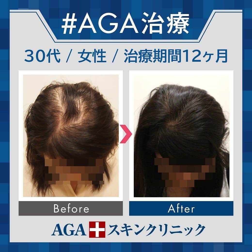 【公式】AGAスキンクリニックさんのインスタグラム写真 - (【公式】AGAスキンクリニックInstagram)「⭐️AGAスキンクリニック　Before⇒After⭐️ . 〇30代女性のケース 〇治療期間12か月 〇内容 ⇒オリジナル発毛薬 ⇒Dr'sメソ治療（AGA メソセラピー） . 女性に多い分け目の薄毛、しっかり改善されました😊 髪のツヤも出てきていますね👸 女性のご相談も増えています！ . クリニックなど詳細は、@aga_clinic より公式HPをチェックしてみてください🥰 . . #AGAスキンクリニック #AGA #薄毛 #抜毛 #発毛 #育毛 #治療 #薬 #ミノキシジル #ヘアー #AGAスキンクリニック症例 #AGA治療 #男性ホルモン #スピロノラクトン #M字 #てっぺん #円形」7月7日 12時44分 - aga_clinic