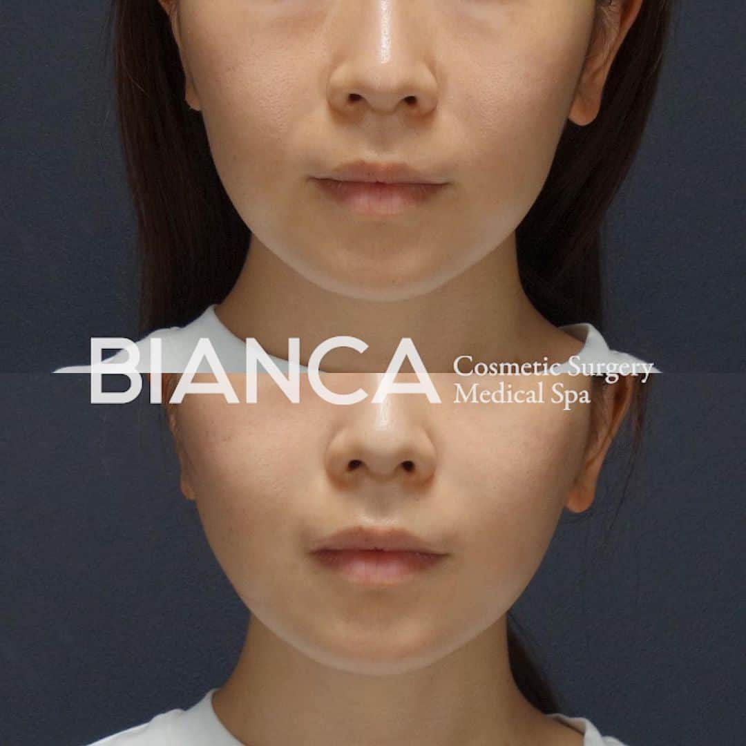 辻沢由有（BIANCA CLNIC 表参道院 院長）さんのインスタグラム写真 - (辻沢由有（BIANCA CLNIC 表参道院 院長）Instagram)「【たるみケアは全人類必須‼️】﻿ ﻿ 上 手術前﻿ 下 手術直後﻿ ﻿ リフトアップ＆お肌の治療は、﻿ 例外なく全ての方に私がオススメする﻿ 治療です👩‍⚕️﻿ ﻿ そしてBIANCALIFTで更に﻿ リフトアップ効果が上がり﻿ ダウンタイムも最小になりました🔥﻿ ﻿ たるみの予防はしていて損は絶対ありません❗️﻿ 特殊な【コグ（トゲ）】が、﻿ コラーゲンの生成の秘密㊙️です😉✨﻿ ﻿ ﻿ 💉 BIANCALIFT﻿ 💴 10本／ 300,000円﻿ ▶ 🉐モニター 198,000円﻿﻿ ﻿ 😷 腫れ、内出血:数日〜1週間程度﻿ ﻿ ⚠️ご予約の際はお電話にて﻿ 『Dr Yuu（辻沢）のインスタ見た』の一言を必ずお願いします👩‍⚕️✨﻿ ﻿ 📍BIANCA CLINIC﻿ ✔︎表参道院﻿ 03-6433-5994﻿ 東京都港区南青山5-11-10  南青山511ビル 2F﻿ ✔︎銀座院﻿ 03-6263-2690 ﻿ 東京都中央区銀座1-5-6 銀座レンガ通り福神ビル 4F﻿ 診療時間 10:00～19:00﻿ 年中無休（年末年始を除く）﻿ ﻿ ﻿ #美容好き#プチ整形#美魔女#メンズ美容 #美容垢#綺麗になりたい #美容皮膚科 #美容外科 #cosmeticsurgery #plasticsurgery #biancaclinic #ビアンカクリニック #プレ花嫁さんと繋がりたい #followｍe #フォローミー #銀座 #女医 #モニター募集 #モニター募集中﻿ #若返り #リフトアップ #スレッドリフト #メンズエステ #メンズビューティー  #小顔 #たるみ #たるみ治療#女医 #ダイエット#dryuu小顔」7月7日 9時22分 - i_am_yuu__