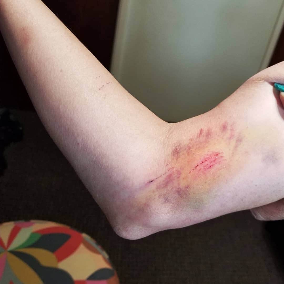 Garyさんのインスタグラム写真 - (GaryInstagram)「Margo has vowed that my next instance of grevious bodily harm will be because of her, not Alice. #margoylemonday #malice Swipe to see day 1 & day 3 of my arm (Friday's post when I got TKO"d by the fence getting Alice from the neighbor's yard)」7月7日 11時01分 - omgdeedee