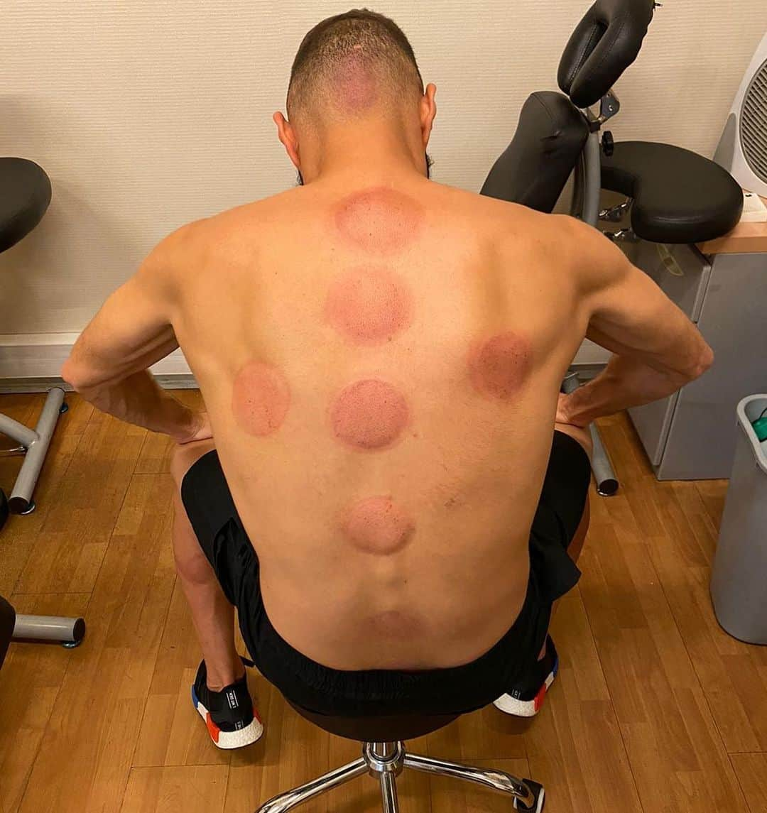 カリム・ベンゼマさんのインスタグラム写真 - (カリム・ベンゼマInstagram)「Alhamdulillah 🤲🏼 #hijamatherapy」7月7日 21時55分 - karimbenzema