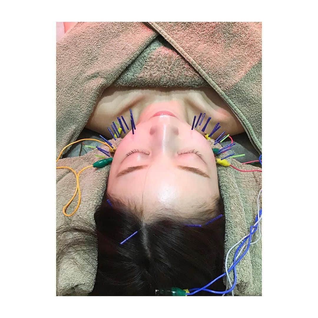 吉川千愛さんのインスタグラム写真 - (吉川千愛Instagram)「人生初の美容鍼してきた🥺✨﻿ ﻿ 丁寧にカウンセリングして﻿ くださって﻿ 状態も言わずとも﻿ わかってくださったり、﻿ 悩みもきいてくれて﻿ 美容鍼をしてもらいました！！﻿ ﻿ むくみとか体調も﻿ 改善できるって✨﻿ 効果も数日後から﻿ 感じれるみたいで楽しみだあ❣️﻿ ﻿ @haricchi_fukuoka さんで﻿ してもらったよ❤︎﻿ ﻿ #ハリッチ　#ハリッチ福岡院 #福岡　﻿ #美容鍼灸　#天神﻿ #fukuoka #tenjin﻿ #LinQ #吉川千愛　﻿ #こんにちあ﻿ #あいんちゅ」7月8日 19時30分 - chiaki_yo