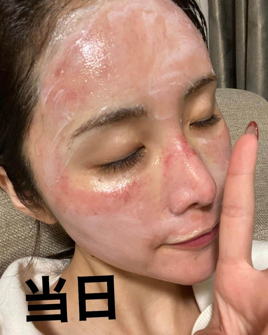 CHIHAさんのインスタグラム写真 - (CHIHAInstagram)「自粛前の話になってしまうのだけど、﻿ @pruge_clinic でぷるぷるフェイス(PRPのダーマペン)を受けてきたよ❤️﻿ ﻿ ※３枚目からちょっとびっくりしちゃうかもしれないから一応閲覧注意です🥺🙏﻿ ﻿ ﻿ 自分の血液を使った成長因子(PRP)をダーマペンという細い針で肌の奥に入れていくの❤︎﻿ 再生能力が高まって、お肌が生まれ変わるんだ！﻿ ﻿ ﻿ 施術当日は画像３枚目の通り真っ赤だったけど、﻿ 翌朝には２枚目のように所々赤みがあるくらいにひいていたよ✨﻿ ﻿ ﻿ 施術後はたっぷり保湿して過ごします❤️﻿ ニキビ跡や、クレーターが気になる方にもいいみたい！﻿ ﻿ ﻿ ﻿ ﻿ 成長因子は、20代前半をピークに活性率が徐々に減少していくらしいからやってみてよかった❤️﻿ ﻿ ﻿ 過去にもプルージュクリニックのPRPで切らずに目の下のクマを取ったり、﻿ こけた頬を改善してもらったりしていて、﻿ 信頼できる大好きなクリニックです❤️🥰﻿ ﻿ ﻿ ﻿ #prugeclinic #PRP #成長因子　#美容 #prp治療 #美容 #美肌　#ダーマペン」7月8日 20時18分 - chiha6170