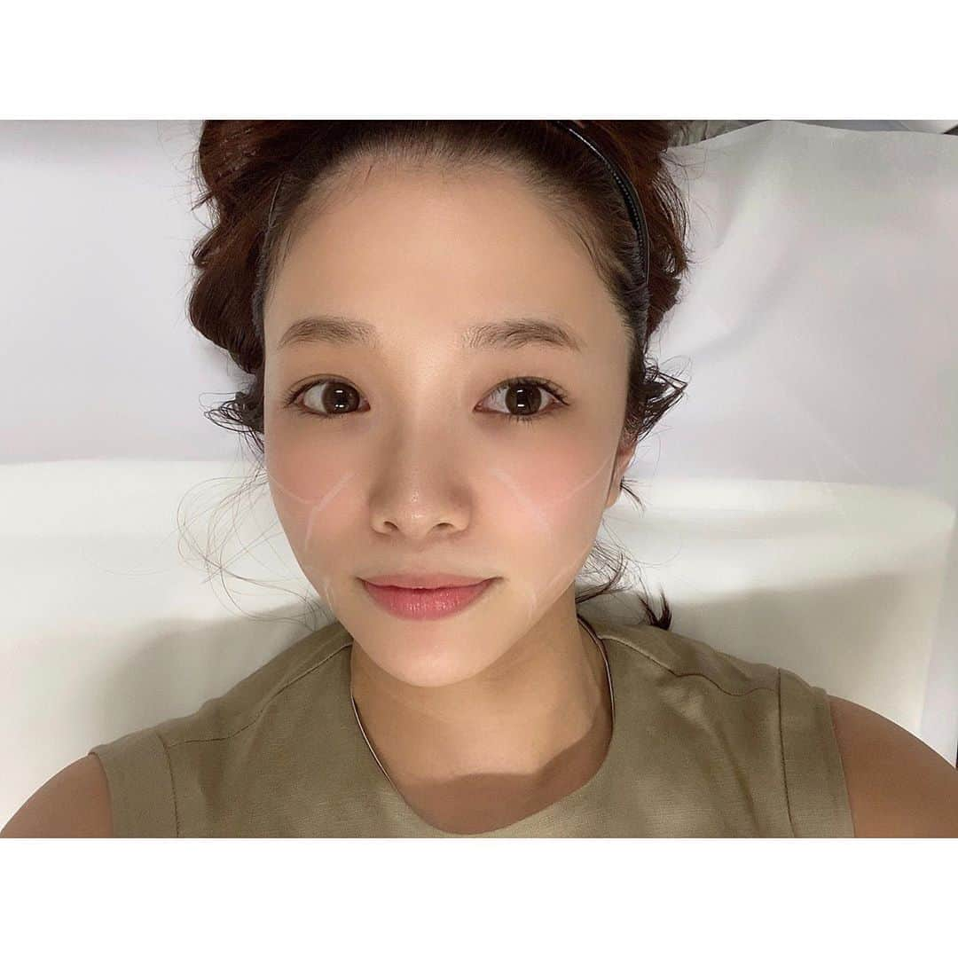 川村茉由さんのインスタグラム写真 - (川村茉由Instagram)「今日は @himeclinic へ✨ 今日は最高の組み合わせ！ ⭐︎ハイドラフェイシャルで 毛穴のお掃除をして…(動画1つ目) ⭐︎レーザートーニングで シミ予防、肌のトーンアップ ⭐︎ベビースキンピール(PQAGE)は ニキビ予防、毛穴が小さくなる、 内側からのツヤ感など… いろんなことに効果が期待できる！(動画2つ目) ⭐︎エレクトロポレーション 肌の深層に美肌成分を浸透 させる！(動画3つ目) * ストーリーにも詳しく 載せたのでぜひ見てみて ください💕 * そしてこの前… 前回から3ヵ月たったので、 HIFUの2回目を 受けてきましたー🥺 痛いけど…けど！！！ 顔の左右差なくなってきたし、 アゴ裏のたるみも減って、 特にずっと気になってた ほうれい線がもうほとんど 薄くなった❤️スゴイ。 * 本当に1年前と驚くほどに 肌質が変わってびっくりしてる。 ずーっとニキビ肌と 付き合っていくしかないなと 思ってたから💭 あぁ…肌がきれいになると 自信がもてます🥰 * #himeclinic #ヒメクリニック #美容 #美容皮膚科 #hifu #ハイドラフェイシャル #pqage #レーザートーニング #エレクトロポレーション #イオン導入」7月10日 0時48分 - mayupi_k