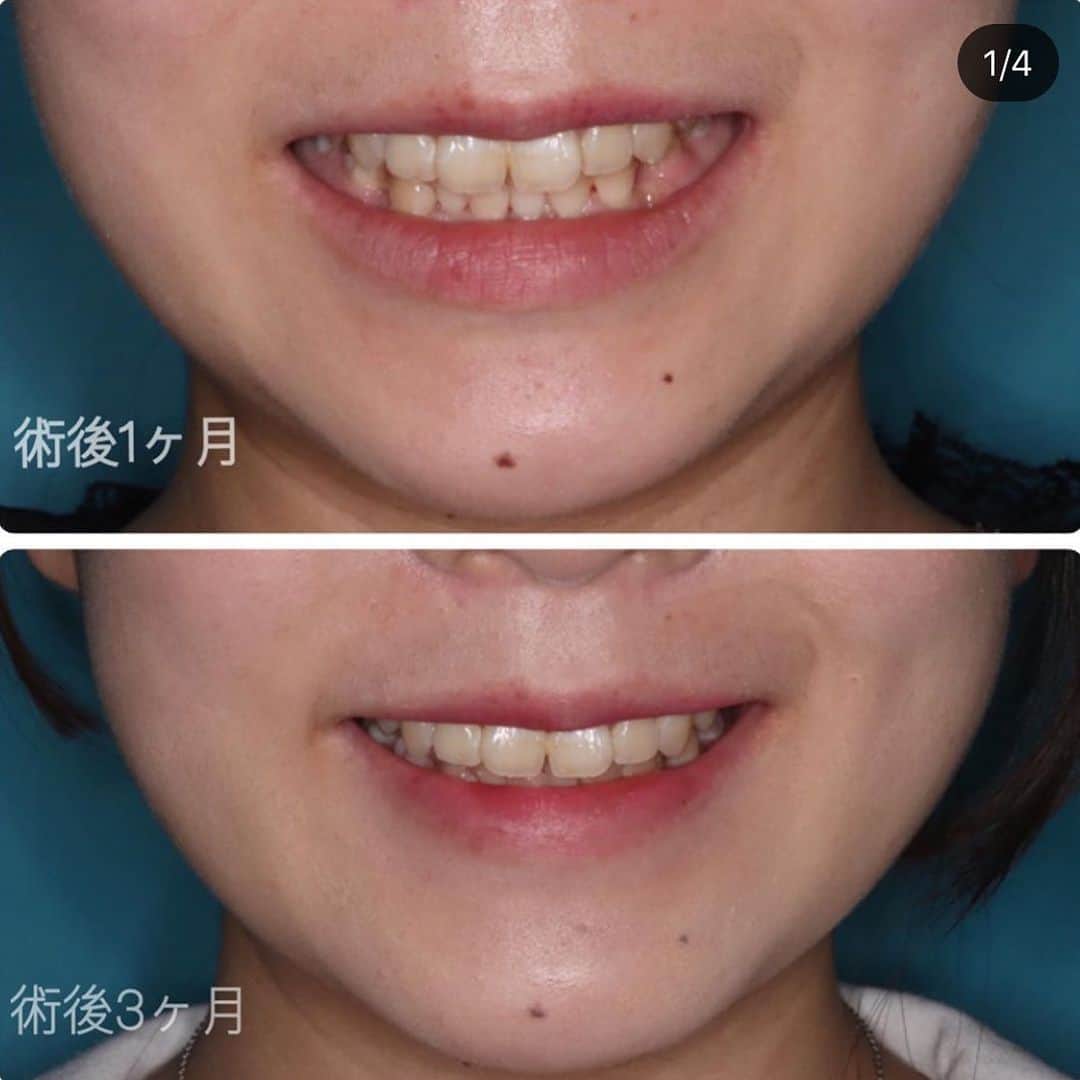 ミライ美デザイン｜大塚美容形成外科・歯科さんのインスタグラム写真 - (ミライ美デザイン｜大塚美容形成外科・歯科Instagram)「@otsukabiyo_dental より ■ドクターコメント スマイルラインがとても綺麗につくれるようになっています。 3ヶ月経つと経過観察も一旦終了になります。  ■手術名 上下顎前方（前歯部）歯槽骨骨切り術 ■術式 　上下左右前から数えて4番目の歯を抜きます。抜いた歯の部分の骨を切って口元をさげます。 ■費用 ￥1.000.000 ■入院 　3泊 ■リスク　　術後の疼痛・腫脹　痺れ・麻痺 ■副作用　　投薬によるアレルギー反応 ■リスク副作用に対する予防　疼痛：鎮痛剤の投与　痺れ・麻痺：抜糸後のストレッチ  投薬によるアレルギー反応 ：術前の問診  #セットバック#口元#口もと#Eライン#顎がない#オトガイ形成術#ゴボ#保坂太一#歯並び#横顔　#常勤麻酔科医　　#骨切り　#大塚美容形成外科#モニター募集　#カウンセリング無料#上下骨切り#歯　#痛みのない治療#トリビュー#セラミック#ジルコニア#3泊4日美人#Zirconia#ceramic#歯科衛生士募集」7月10日 17時28分 - otsukabiyo