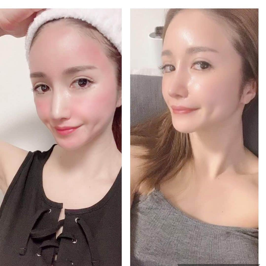 ゆみさんのインスタグラム写真 - (ゆみInstagram)「before✨after  ダーマペン5日目から肌がピカーン✨ ってなりました✨ 毛穴引き締まって 肌のトーンも上がって 表面の凹凸もない👏🏻‼️  今回深めに打って貰ったので3日間は顔の赤み引かなかったです🥺  #ダーマペン #シャネル注射 #美容レーザー #美容 #アンチエイジング #美肌 #美白 #毛穴 #たるみ #ニキビ跡 #ダウンタイム   ダウンタイムが長ければ長い施術ほど結果が良い👏🏻✨」7月12日 5時42分 - kimurasan2008