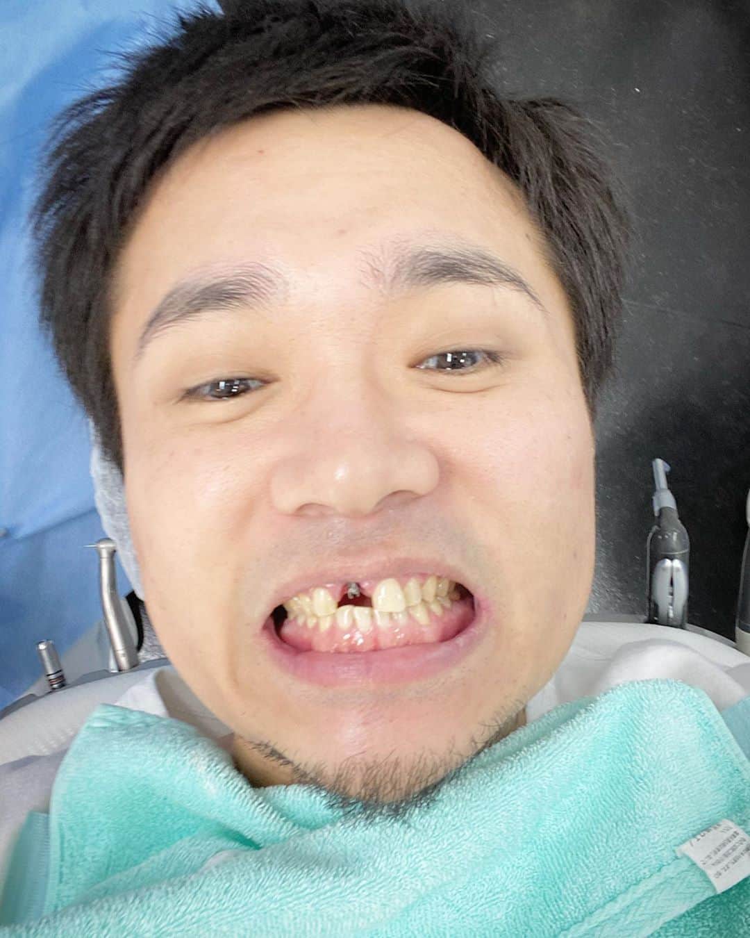 光本勇介のインスタグラム：「インプラント（差し歯）を取り替えてる😌」