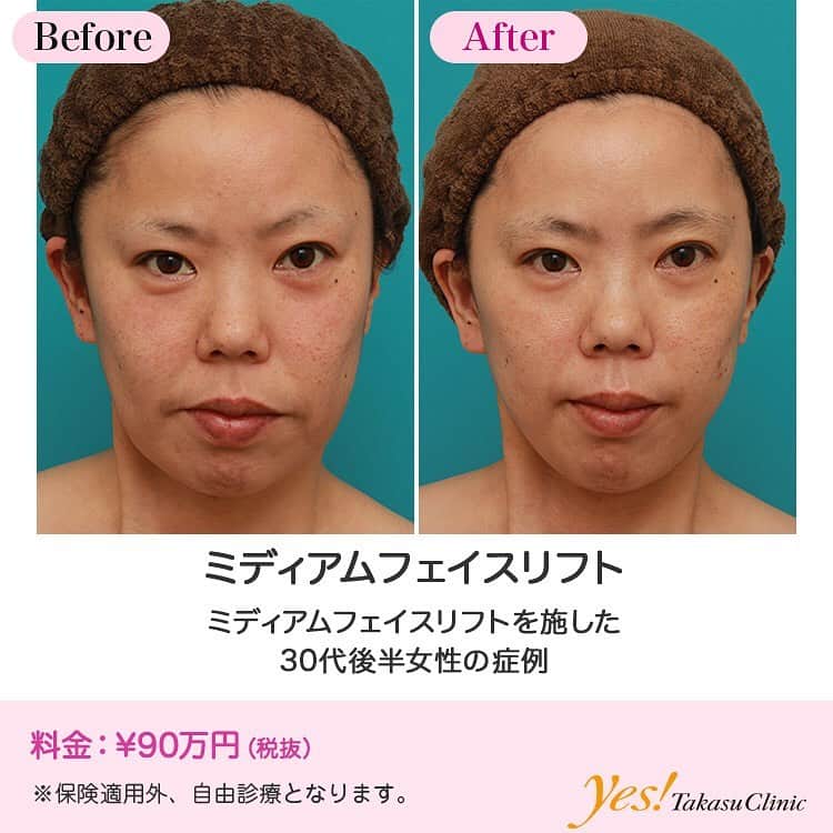 高須クリニックのインスタグラム：「👨🏻‍⚕️高須幹弥医師からのコメント✨⠀ 30代後半の女性で、顔のたるみの改善、エイジングケアを希望されていました。 診察させていただいたところ、年齢相応に顔全体がたるんでおり、特に、頬、フェイスライン、顎下のたるみが目立っていました。 患者様は、「1週間はダウンタイム取れるし、切ってもいいので、しっかりエイジングケアしたい」というご要望でしたので、ミディアムフェイスリフトをすることになりました。 手術は、頭髪の減少やもみ上げの後退がなるべく起こらないように、こめかみの生え際~頭髪内~耳の前~耳の少し後ろにかけて皮膚切開するデザインで行いました。 リテイニングリガメントを切離処理した後、SMAS（スマス）を引き上げ固定し、余った皮膚を切除した後、丁寧に皮膚縫合しました。 手術後は程よく頬のたるみがリフトアップされ、フェイスラインや顎下のたるみがすっきりしました。 リフトアップのエイジングケアは、ウルセラシステムやサーマクールなどの照射系治療、イタリアンリフトなどの糸のリフトアップ治療、ミディアムフェイスリフト、フルフェイスリフトなどの切開する治療がありますが、ダウンタイムが取れて、しっかりとエイジングケアしたいという方は、切開する治療が最も効果的です。 ---------------------------------------------------- 🌈料金✨⠀ ●ミディアムフェイスリフト ¥900,000【東京、横浜、名古屋、大阪】 ---------------------------------------------------- ⚠️リスク・副作用・合併症✨⠀ ●ミディアムフェイスリフト 切開した周辺の腫れ（術後） 仕上がりのわずかな左右差（完璧なシンメトリーは不可） 傷跡が肥厚性瘢痕やケロイドになる可能性 感覚が鈍くなる可能性 手術後の血腫 --------------------------------------------------- 😊施術についての詳細✨⠀⠀ https://www.takasu.co.jp/photo/mediumlift007.html ---------------------------------------------------- 📞ご予約・お問い合わせ✨⠀ 0120-5587-10⠀ https://www.takasu.co.jp/cgi-bin/form/contact.cgi ※症例写真や施術に関するご質問なども上記までお願い致します。 ---------------------------------------------------- #ミディアムフェイスリフト #顔のたるみの改善 #頬のたるみ #フェイスラインのたるみ #顎下のたるみ  #皮膚 #美容 #美肌 #エイジングケア #美容整形 #美容外科 #美容クリニック #美容好き #美容皮膚科 #モニター #モニター募集 #高須クリニック #高須クリニック名古屋 #高須幹弥 #整形したい #プチ整形 #症例 #症例写真 #可愛くなりたい #可愛い #美人」