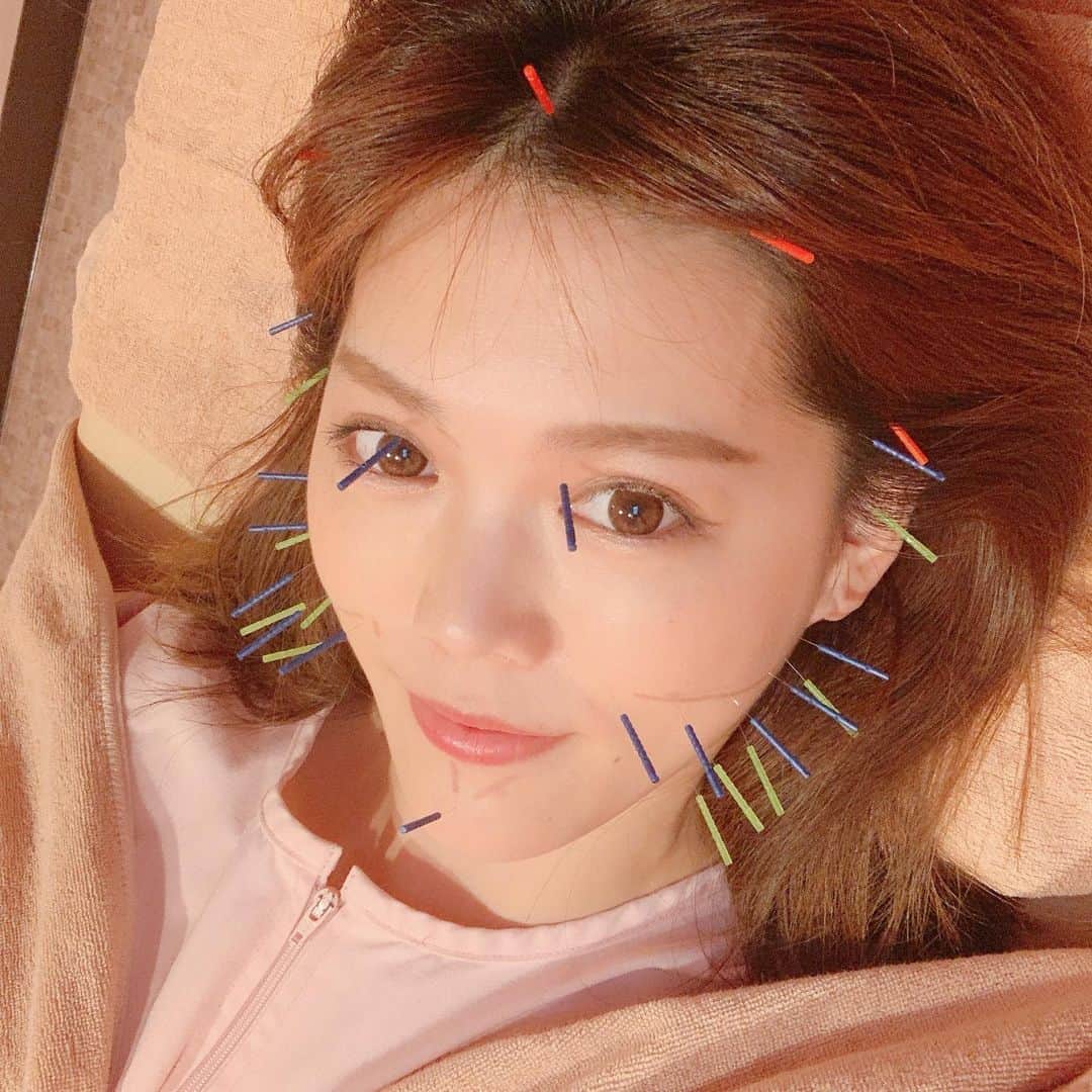上坂由莉のインスタグラム：「﻿ ﻿ 今日は美容鍼へ〜🥰 @sbc.tokyo﻿ いつも東洋医学、美容や健康のお話を﻿ 沢山教えてもらえて毎回行くのが楽しみなんです😍﻿ ﻿ ﻿ 今日はお腹も固くてお灸で温めてもらいました🥰﻿ そして右首がカッチカチ〜🥶🥶🥶﻿ いつものお顔に加えて首もしっかり鍼を打ってもらって﻿ しっかりほぐしてもらいました👩✨﻿ ﻿ ﻿ 喋ってる中で先生がめちゃくちゃ推してた﻿ 酵素サプリメント気になりすぎて買ってみました😘﻿ 粉末タイプの酵素って初めて〜❗️﻿ ﻿ ﻿ 目的に合わせて飲む時間や本数を変えるようですが﻿ 私はダイエットより浮腫みケアやスッキリ感が欲しいので﻿ 寝る前がオススメらしいのでさっそく今夜から🌙﻿ 1ヶ月続けてみようと思います😊❣️﻿ ﻿ ﻿ #世田谷ビューティクリニーク #鍼灸治療院 #美容鍼﻿ #鍼灸院 #池尻大橋 #世田谷 #肩こり #小顔調整﻿」