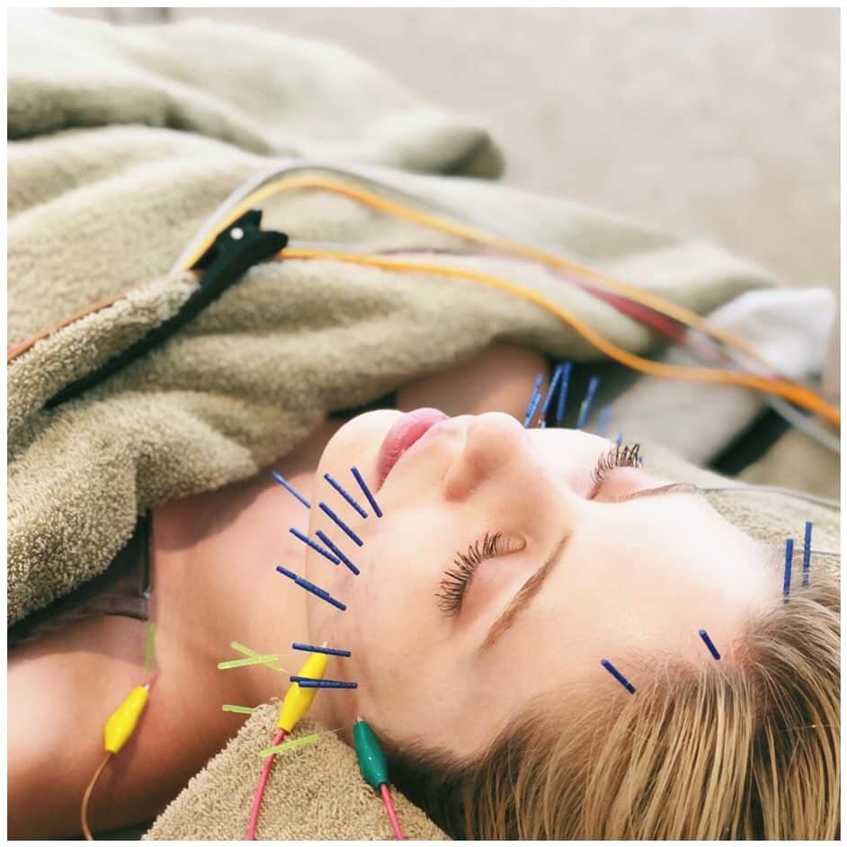 のインスタグラム：「半年ぶりにHaricchiに行って来ました〜✨やっぱり行くと、終わった後の肌のプルプル感、キュって顔が引き締まって、肌もワントーンアップする感じが恋しかった〜いつも通り顔、肩、頭が固まってた！鍼って自律神経、ストレス、肌のターンオーバーや免疫力を高めるのにも良いの！これからもメンテナンス頑張ろう！いつもありがとうございます！ I went to Haricchi after 6months. I missed feeling my skin tight, hydrated and flawless.  My face, shoulders, and head was very tight had ! Definitely needed this. Acupuncture  is good for the nervous system, stress, skin turnover and immunity!Thank you for having me  🇧🇷Eu fui para acupuntura Haricchi depois de 6 meses.  agora está hidratada , levantou bastante .   Meu rosto, ombros e cabeça estavam muito tenso!  Definitivamente precisava disso.  A acupuntura é bom para o sistema nervoso, estresse, renovação da pele e imunidade! Obrigado por me receber ✨ ✨ ✨ ✨ #julianaminato #湊ジュリアナ #ジュリアナ #肌のメンテナンス #はり #肌ケア  #ターンオーバー #acpupuncture #acupunctureclinic #easternmedicine #mindbody #acupuncturist #免疫力アップ #免疫力 #ニキビ跡 #skintherapist #glowingskin #鍼　#はり  #acnescars #綺麗な肌 @ginza_haricchi」