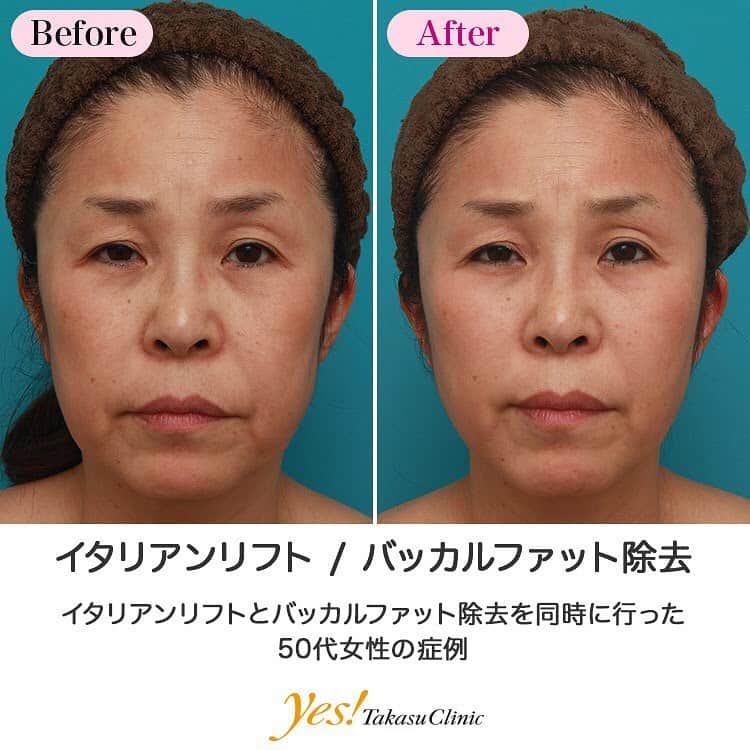 高須クリニックのインスタグラム：「👨🏻‍⚕️高須幹弥医師からのコメント✨⠀ 50代女性の患者様で、エイジングケア治療希望で来院されました。 診察させていただいたところ、年齢相応に顔全体がたるんでおり、特に頬のたるみが目立っていました。 まずはダウンタイムがあまりかからない治療を受けたいというご要望でしたので、イタリアンリフトとバッカルファット除去をすることになりました。 イタリアンリフトは左右の頬に3本ずつ計6本入れ、頬のたるみを内側から持ち上げるようにしました。 バッカルファット除去は、左右から均等に余分に垂れ下がっている分のボリュームを除去し、左右合わせて卵の黄身1個半くらいの脂肪を取ることができました。 術後は、余分な脂肪をボリュームがなくなり、たるんでいた頬もリフトアップされました。 イタリアンリフト+バッカルファット除去の組み合わせは、余分なボリュームを取り、尚且つ、たるんでいる組織をリフトアップして引き締めることができるため、非常に効果的です。 ---------------------------------------------------- 🌈料金✨⠀ ●イタリアンリフト 1本 ¥100,000 / 6本 ¥600,000【全院】 ●バッカルファット除去 ¥300,000 【東京、横浜、名古屋、大阪】 ---------------------------------------------------- ⚠️リスク・副作用・合併症✨⠀ ●イタリアンリフト 麻酔による腫れ・内出血（術後） ●バッカルファット除去 手術後に処方する抗生剤や痛みどめによるアレルギー症状 --------------------------------------------------- 😊施術についての詳細✨⠀⠀ https://www.takasu.co.jp/photo/italian018.html ---------------------------------------------------- 📞ご予約・お問い合わせ✨⠀ 0120-5587-10⠀ https://www.takasu.co.jp/cgi-bin/form/contact.cgi ※症例写真や施術に関するご質問なども上記までお願い致します。 ---------------------------------------------------- #イタリアンリフト #バッカルファット #バッカルファット除去 #顔のたるみの改善 #頬のたるみ  #皮膚 #美容 #美肌 #エイジングケア #美容整形 #美容外科 #美容クリニック #美容好き #美容皮膚科 #モニター #モニター募集 #高須クリニック #高須クリニック名古屋 #高須幹弥 #整形したい #プチ整形 #症例 #症例写真 #可愛くなりたい #可愛い #美人」