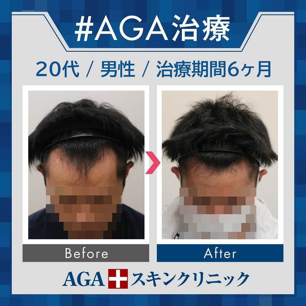 【公式】AGAスキンクリニックさんのインスタグラム写真 - (【公式】AGAスキンクリニックInstagram)「⭐️AGAスキンクリニック　Before⇒After⭐️ . 〇20代男性のケース 〇治療期間6か月 〇内容 ⇒オリジナル発毛薬 ⇒Dr'sメソ治療（AGA メソセラピー） . 治療開始から半年で生え際の形に変化が😲❣ 正面から見た印象もかなり改善されました☺ . AGAは早期治療が肝心です。 クリニックなど詳細は、@aga_clinic より公式HPをチェックしてみてください🥰 . . #AGAスキンクリニック #AGA #男性型脱毛症 #AGA治療 #薄毛 #薄毛治療 #抜毛 #発毛 #育毛 #治療 #薬 #ミノキシジル #AGAスキンクリニック症例 #男性ホルモン #フィナステリド #デュタステリド #初期脱毛 #美容男子 #髪質改善 #頭皮ケア」8月14日 17時59分 - aga_clinic