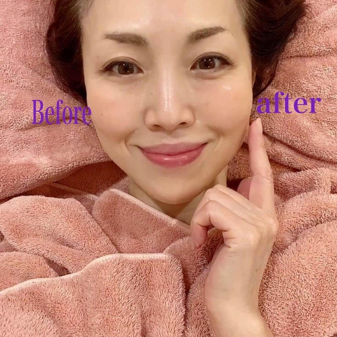 ImotoEtsuyo さんのインスタグラム写真 - (ImotoEtsuyo Instagram)「首から始まって目元周り、 頭皮までケアしてくれる　 最新美容法の『ニードレスインジェクター』を受けに 表参道の @e.pbs_omotesando へ 行ってきました。  このマシーン、針を使わずに エアーを使いナノ単位で お肌の奥へ美容液を浸透させるもの 痛みもダウンタイムも全くなし。 敏感肌の私も大丈夫でしたよ。  人幹細胞培養液をマシーンに入れて 空気の力で導入。 皮下3mmまで溶液が 入るらしいのです！  先ずは、クレンジングの後、 スチームを当てながら 毛穴の汚れを吸引し  その後 エアーニードレスインジェクターで 人幹細胞培養液を導入✨ 仕上げはビタミンでお肌を整えます。  目のキワまで出来るから 小じわも目立たなくなったみたい。  続けてやっていくと、赤ちゃんみたいな艶々、モチモチした肌になれるそうで、 これは続けたいなぁ。  最後の写真は 半顔だけ引き上がってるのわかりますか？ 立体的に小顔になれるのが凄い ハリツヤと透明感も増して嬉しい。  ダウンタイムがなく即効性があるので お肌を整えたい時や 撮影前にもおススメです！  ・ ・ #ワンピース ➡︎ @saturdayclub #サタデークラブ   #表参道　#エステ　#エアー注射　#針無し注射　#ニードレスインジェクター　#ヒト幹細胞　#ヒト幹細胞培養液　#ヒト幹細胞エステ　#ヒアルロン酸　#プラセンタ　#肌再生　#リフトアップ　#モチモチ肌　#毛穴レス　#最新美容機器　#若返り　#完全個室　#プライベートサロン　#隠れ家サロン　#完全予約制」8月15日 6時38分 - bisuhada