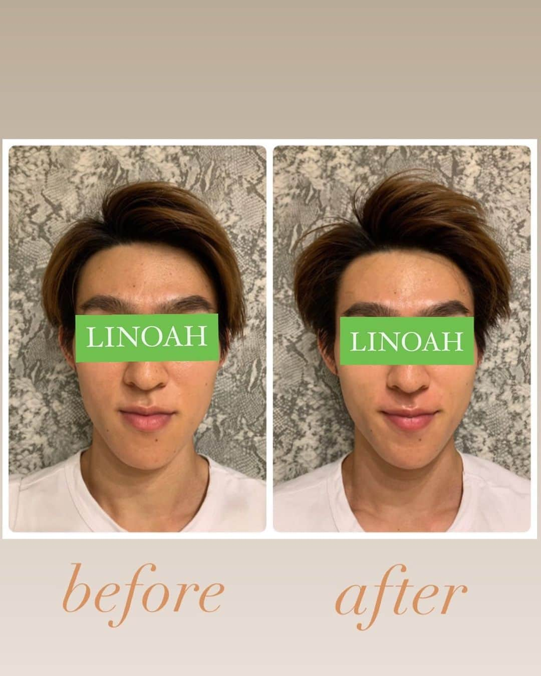 Beauty Salon LINOAHさんのインスタグラム写真 - (Beauty Salon LINOAHInstagram)「３D HIFU（ハイフ）﻿ ⭐️モニターキャンペーン募集中⭐️﻿ 1回5000でお受け頂けます！！﻿ ﻿ ご興味がある方は是非、ご予約お問い合わせいただければと思います。﻿ ﻿ ﻿ 脱毛・フェイシャルBeautySalon　LINOAH　　　　　　　　﻿ 大阪梅田の脱毛・フェイシャル完全予約制のプライベートサロン　　﻿ 男女　性別問わずご利用頂けます。﻿  ﻿  ﻿ 【アクセス】﻿  ﻿ 大阪市北区鶴野町4-11　朝日プラザ914﻿ 阪急 梅田駅茶屋町口 徒歩 5分﻿  ﻿ 【営業時間】﻿ 平日　11:00～22:00（最終受付21：30）﻿ 土日祝　11:00～20:00（最終受付19：30）﻿ ※完全予約制となっております。﻿  ﻿ 【定休日】﻿ 毎週木曜日﻿  ﻿ ご予約はこちらへ﻿ 電話：06-6110-5067 ﻿ ﻿ ﻿ #大阪 #梅田 #脱毛 #メンズ脱毛 ﻿ #レディース脱毛 #フェイシャル #エステ #beautysalonlinoah ﻿ #ビューティーサロンリノア ﻿ #プライベートサロン ﻿ #フォトフェイシャル ﻿ #男性 #女性 #lgbt ﻿ #安心 #美肌 #美白 #しみ #シワ ﻿ #ニキビ #ニキビ跡 ﻿ #リフトアップ #小顔 #ハイフ#HIFU﻿ #ヒゲ #顔 #青ひげ #カミソリ負け #美意識 ﻿ ﻿」8月15日 11時21分 - beautysalon_linoah